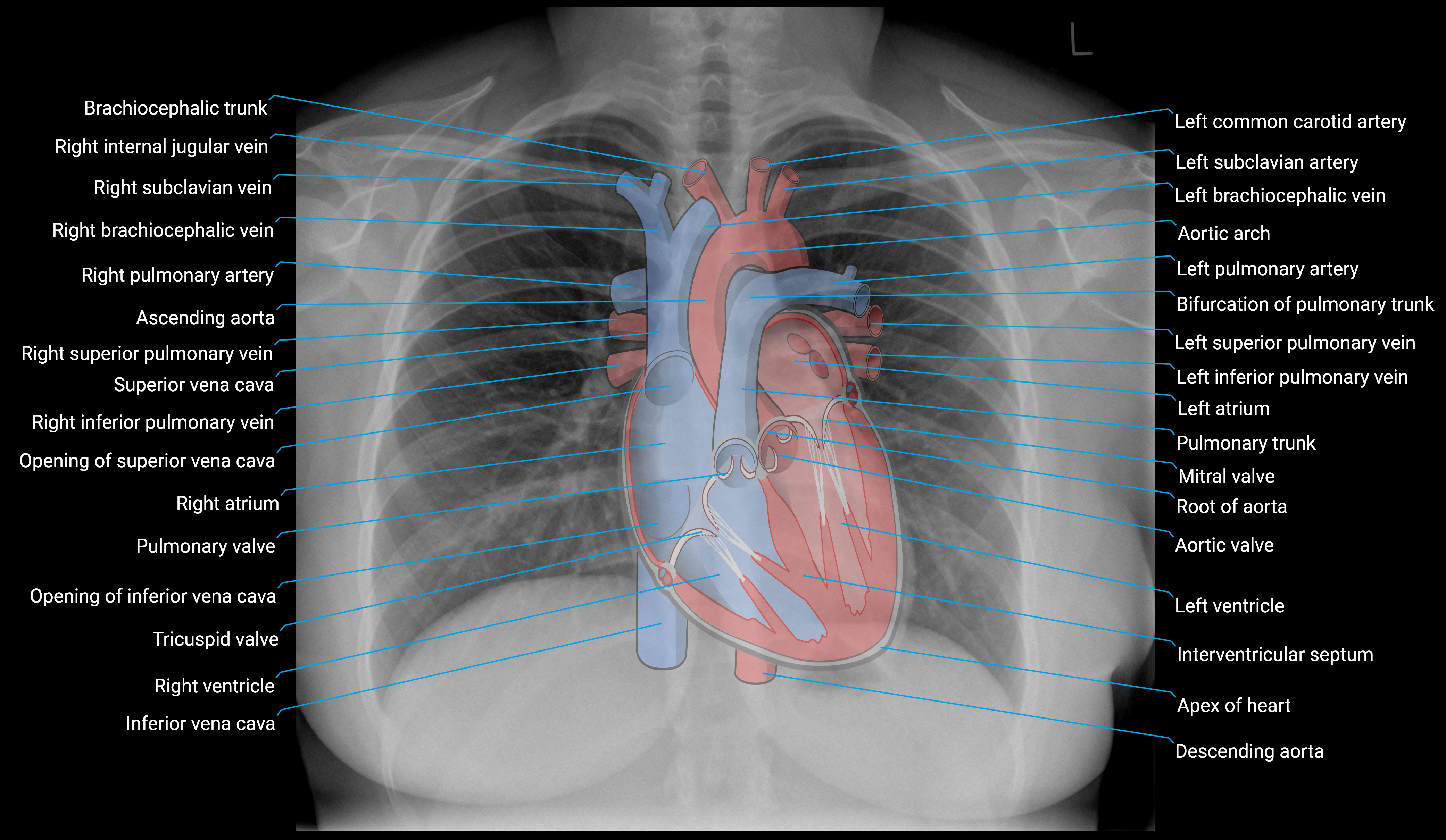 Sternum Rx Chest X-ray Anatomy – AP & Lateral Views, Labeled CXR, Normal Chest Anatomy
