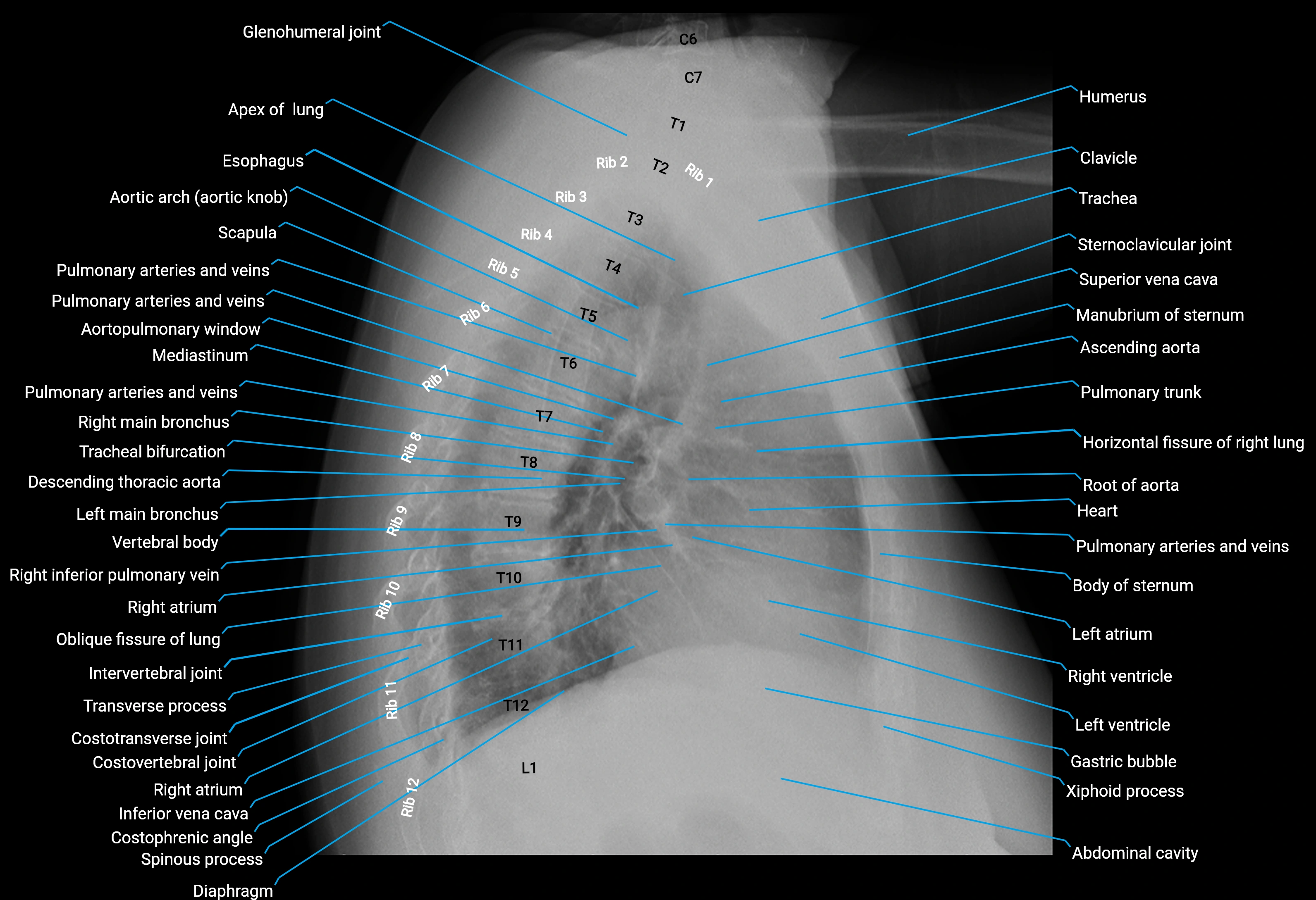 Chest X-ray Anatomy – AP & Lateral Views, Labeled CXR, Normal Chest Anatomy