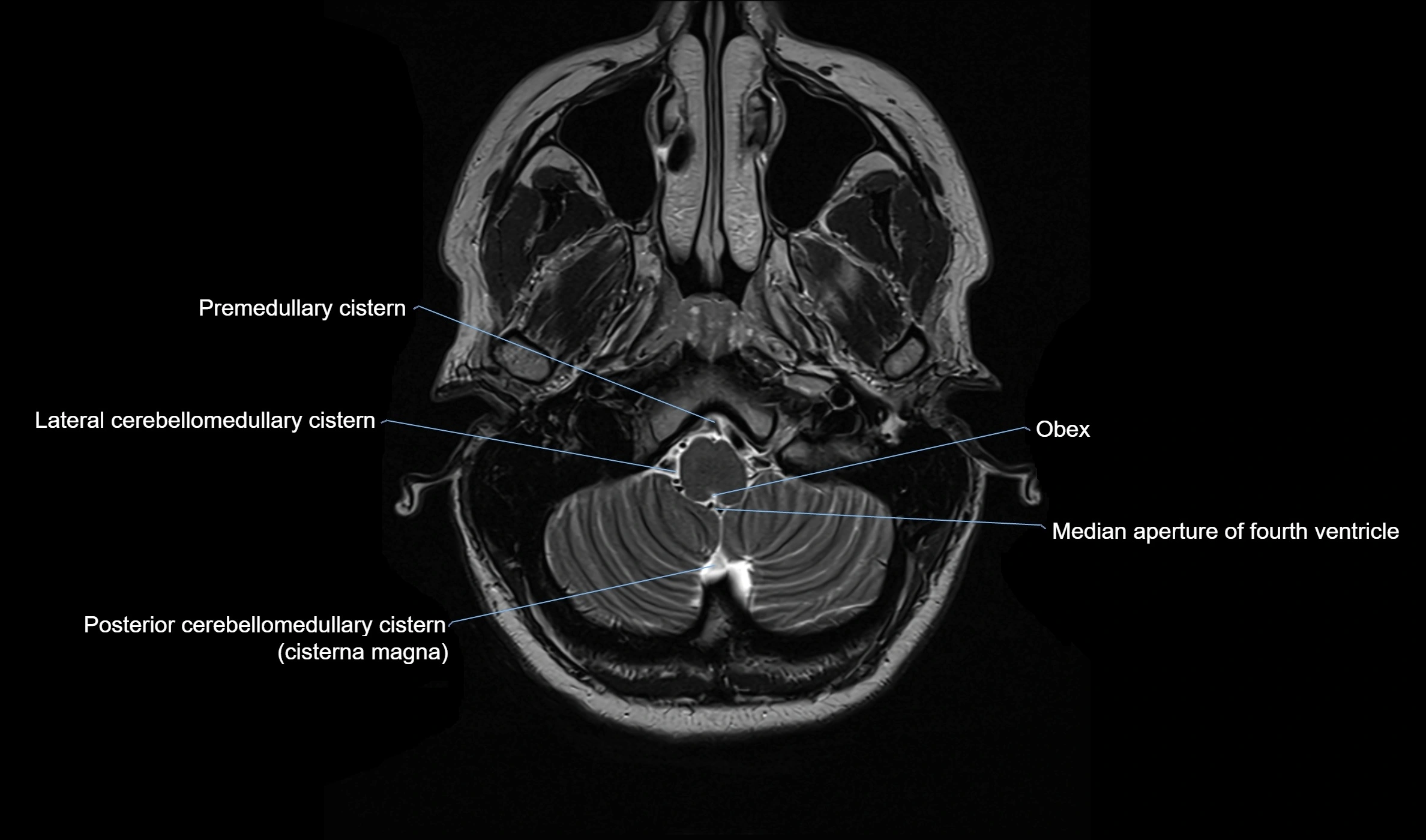 MRI-Brain-cisterns--and-ventricles--axial-anatomy-3T-MRI-image-00005.webp