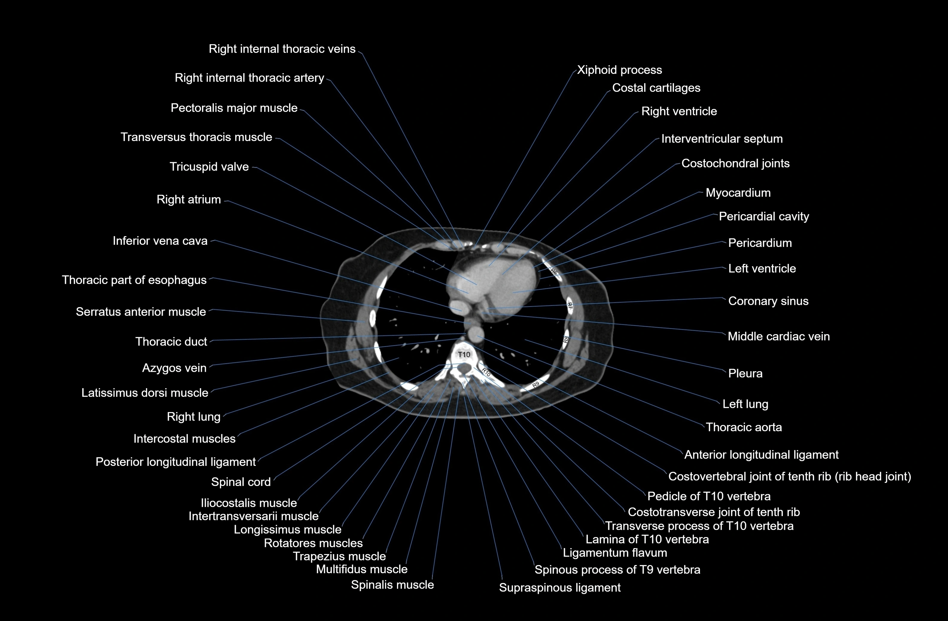 CT Abdomen & Pelvis (Female) Anatomy – Labeled Axial, Coronal ...