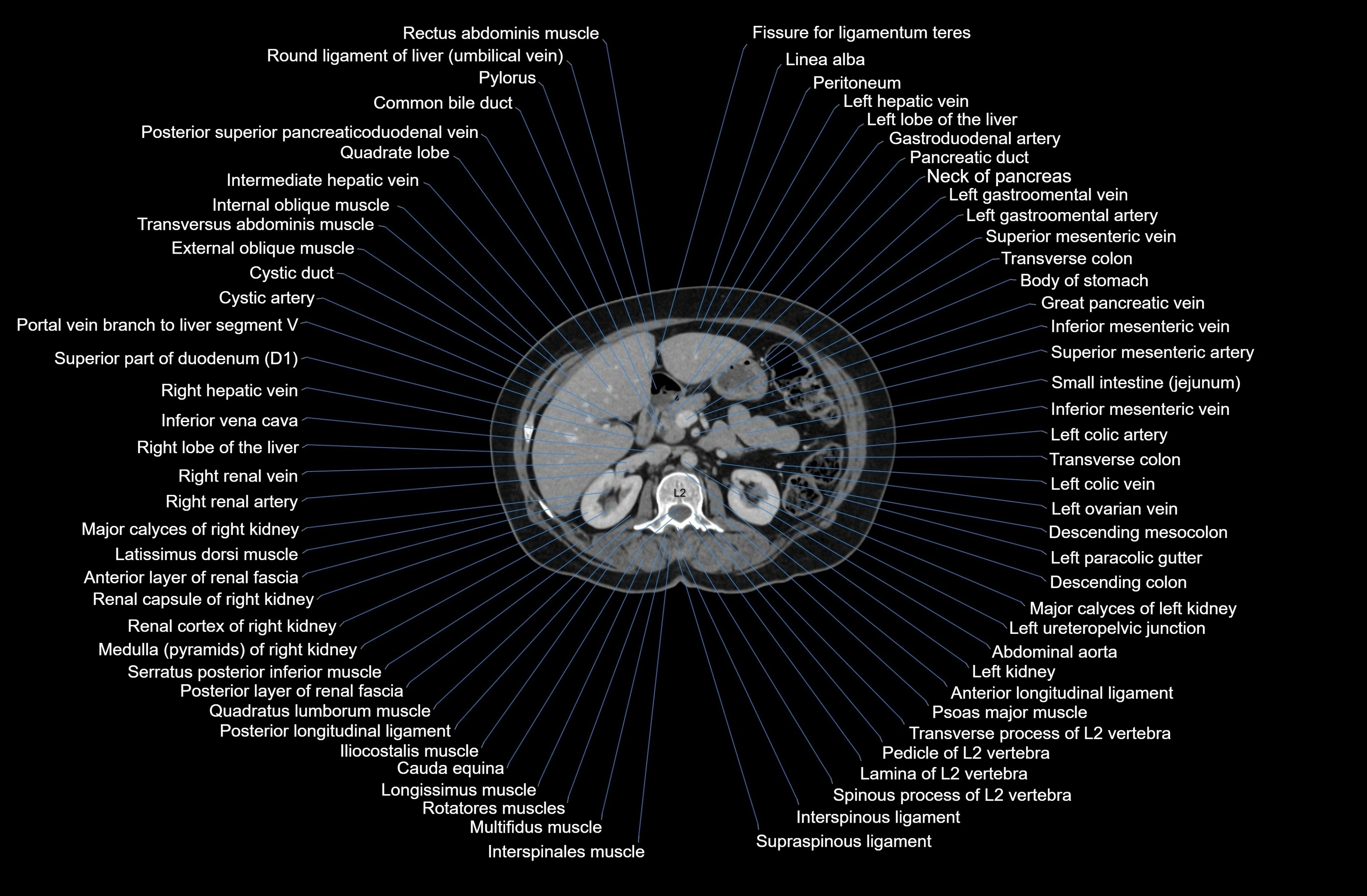 CT Abdomen & Pelvis (Female) Anatomy – Labeled Axial, Coronal ...