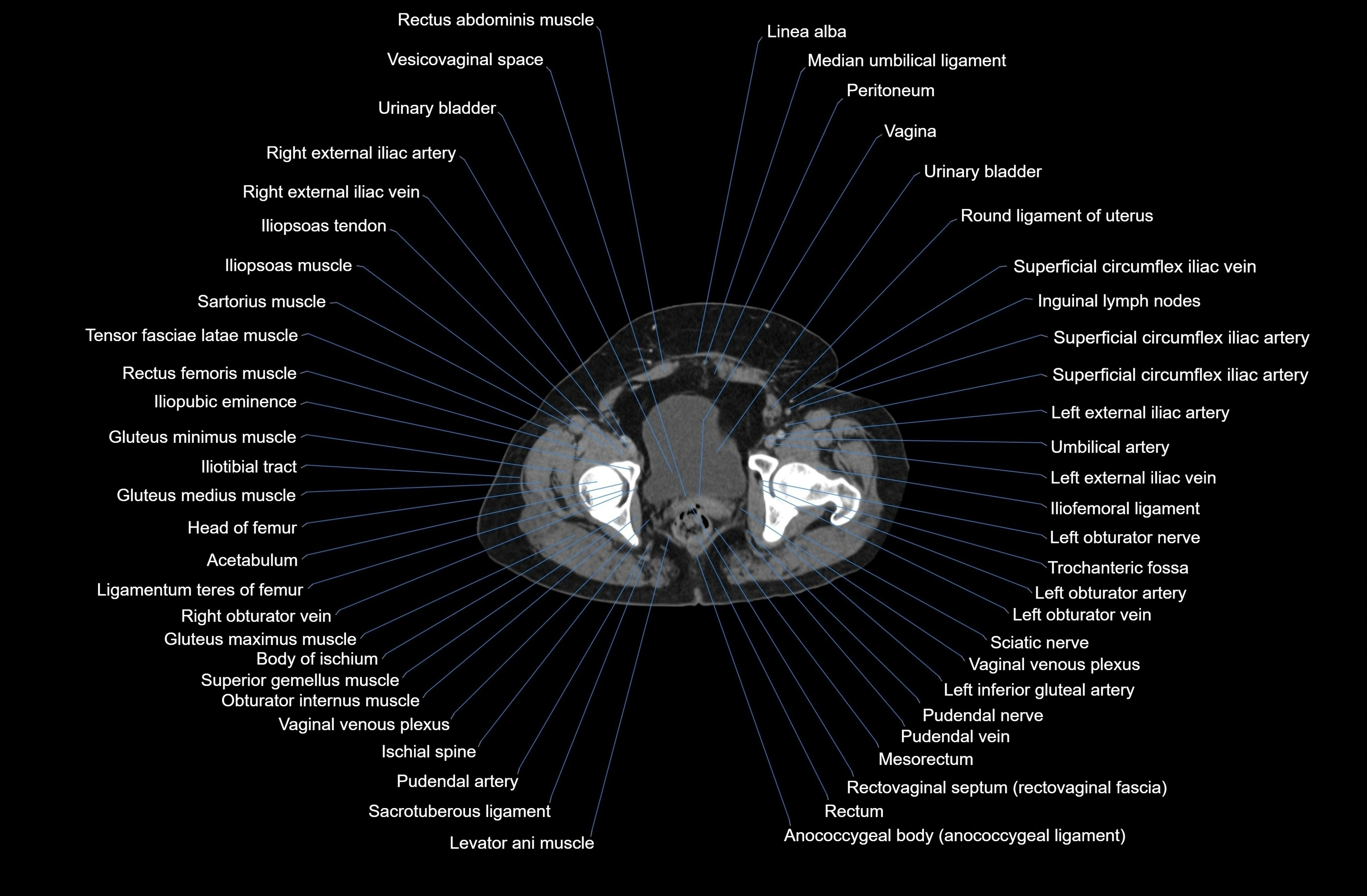 CT Abdomen & Pelvis (Female) Anatomy – Labeled Axial, Coronal ...