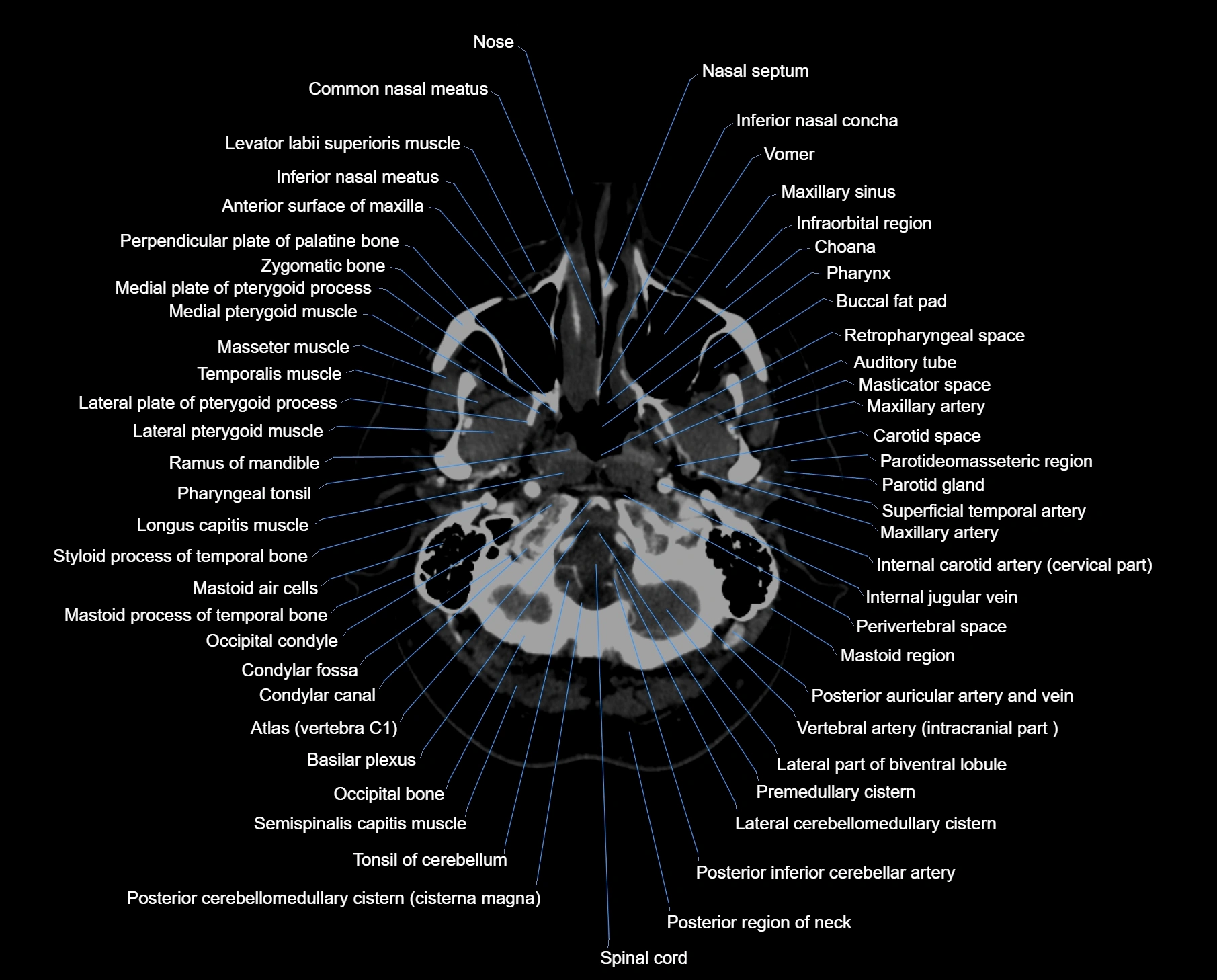 CT_scan_brain_axial_labelled_cross_sectional_anatomy_image-img-00004.webp