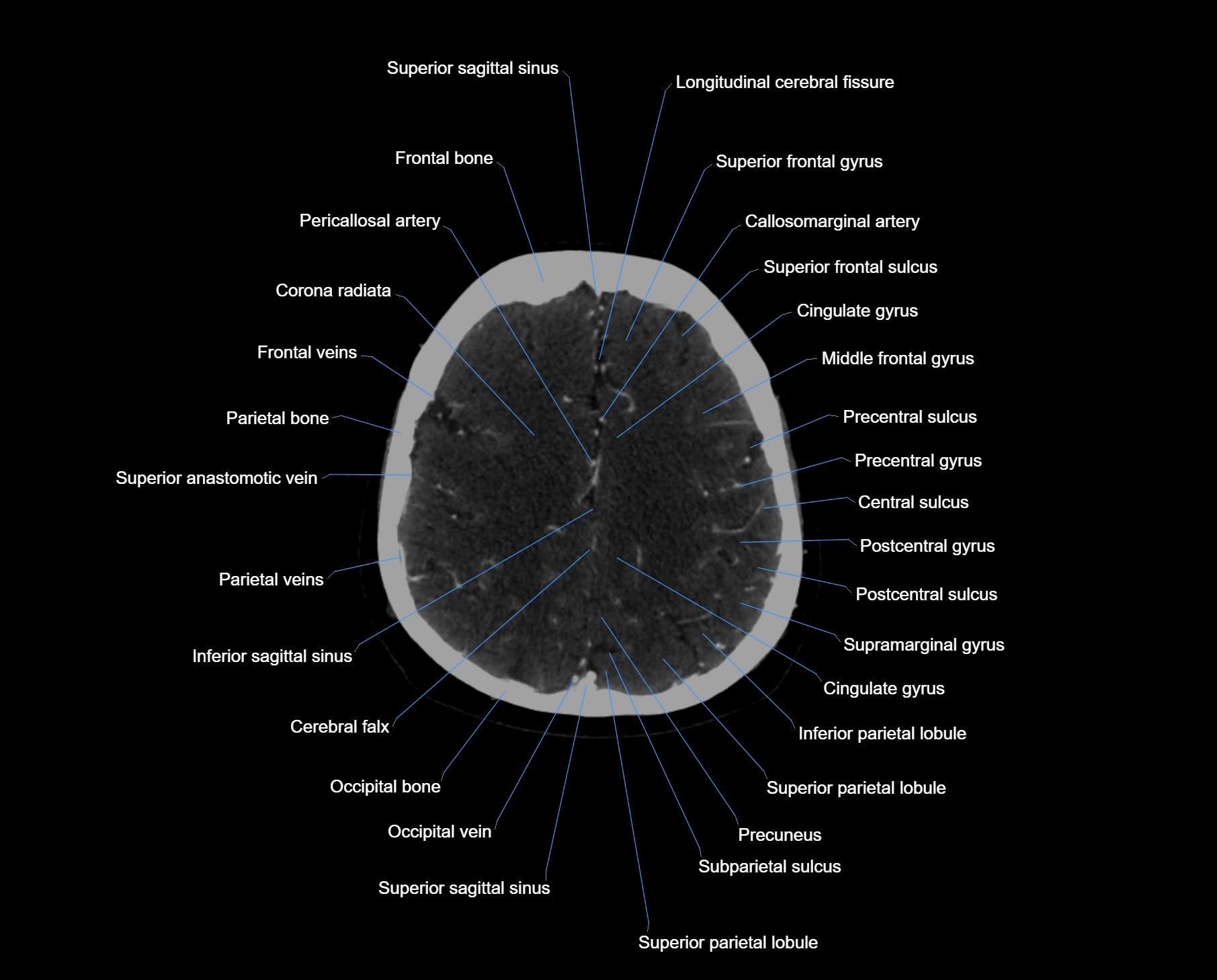 CT_scan_brain_axial_labelled_cross_sectional_anatomy_image-img-000051.webp