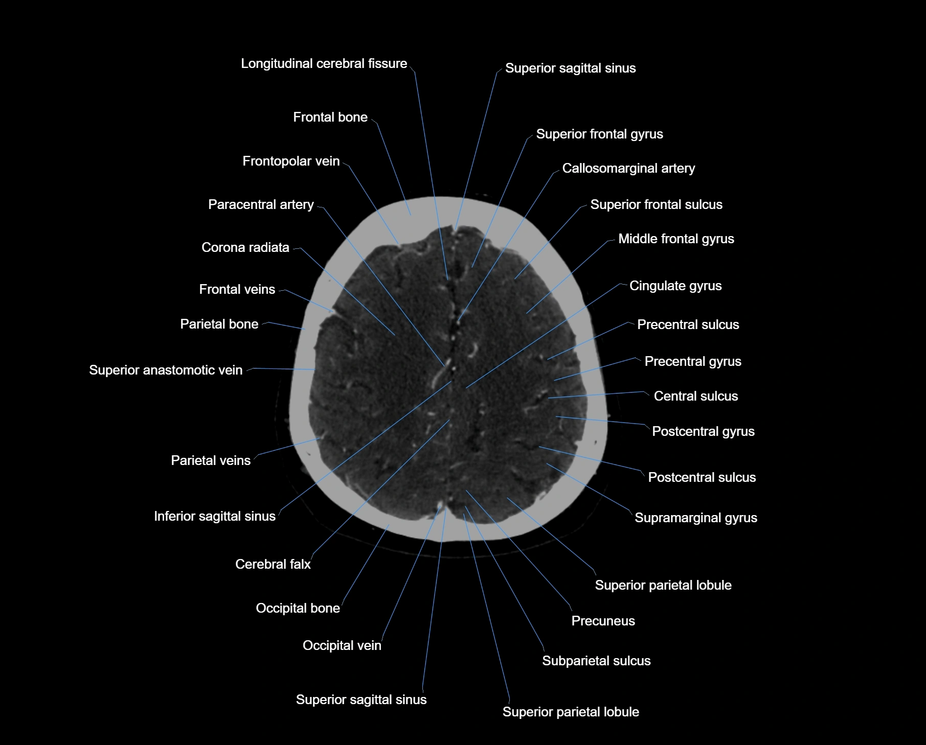 CT_scan_brain_axial_labelled_cross_sectional_anatomy_image-img-000054.webp