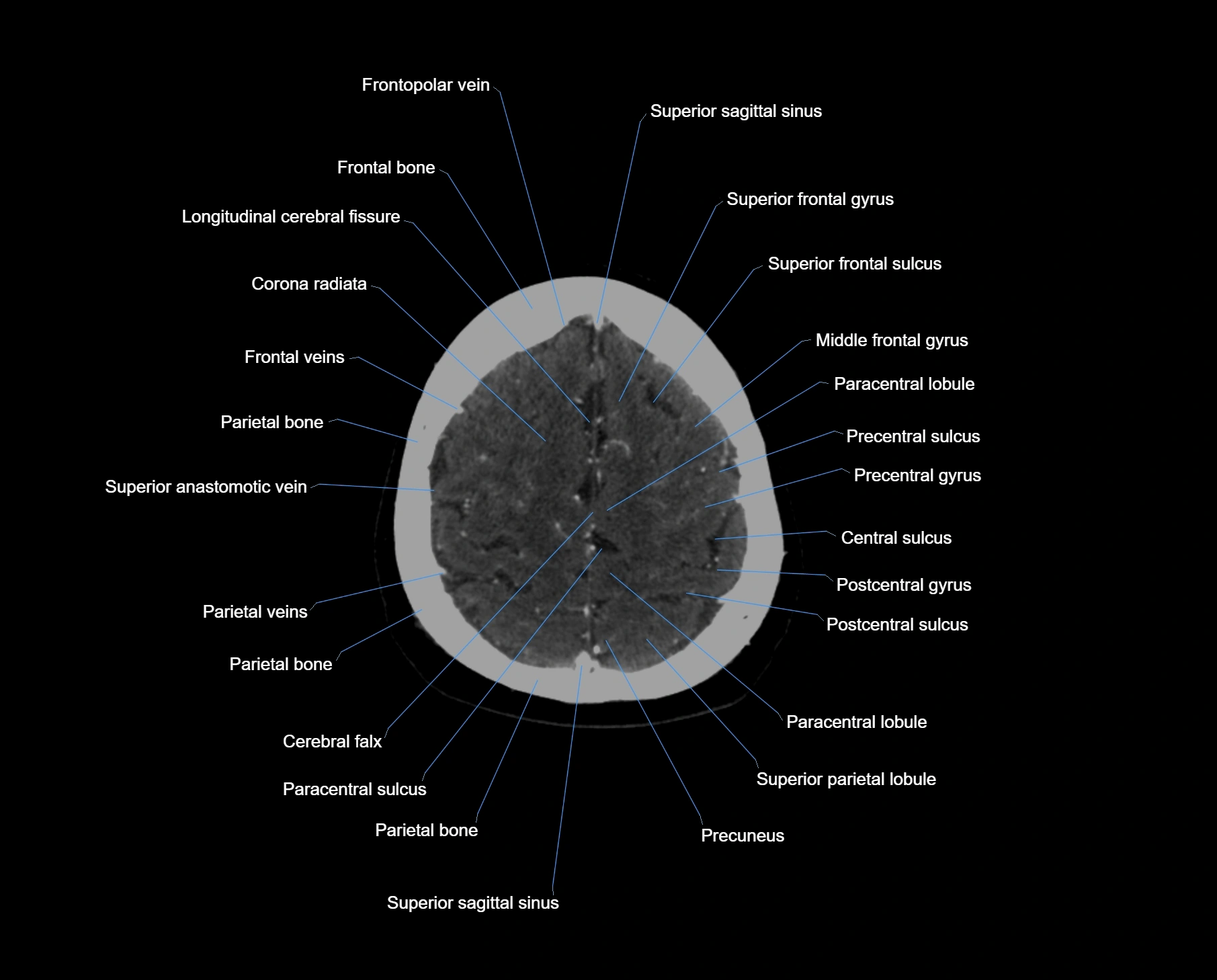 CT_scan_brain_axial_labelled_cross_sectional_anatomy_image-img-000059.webp