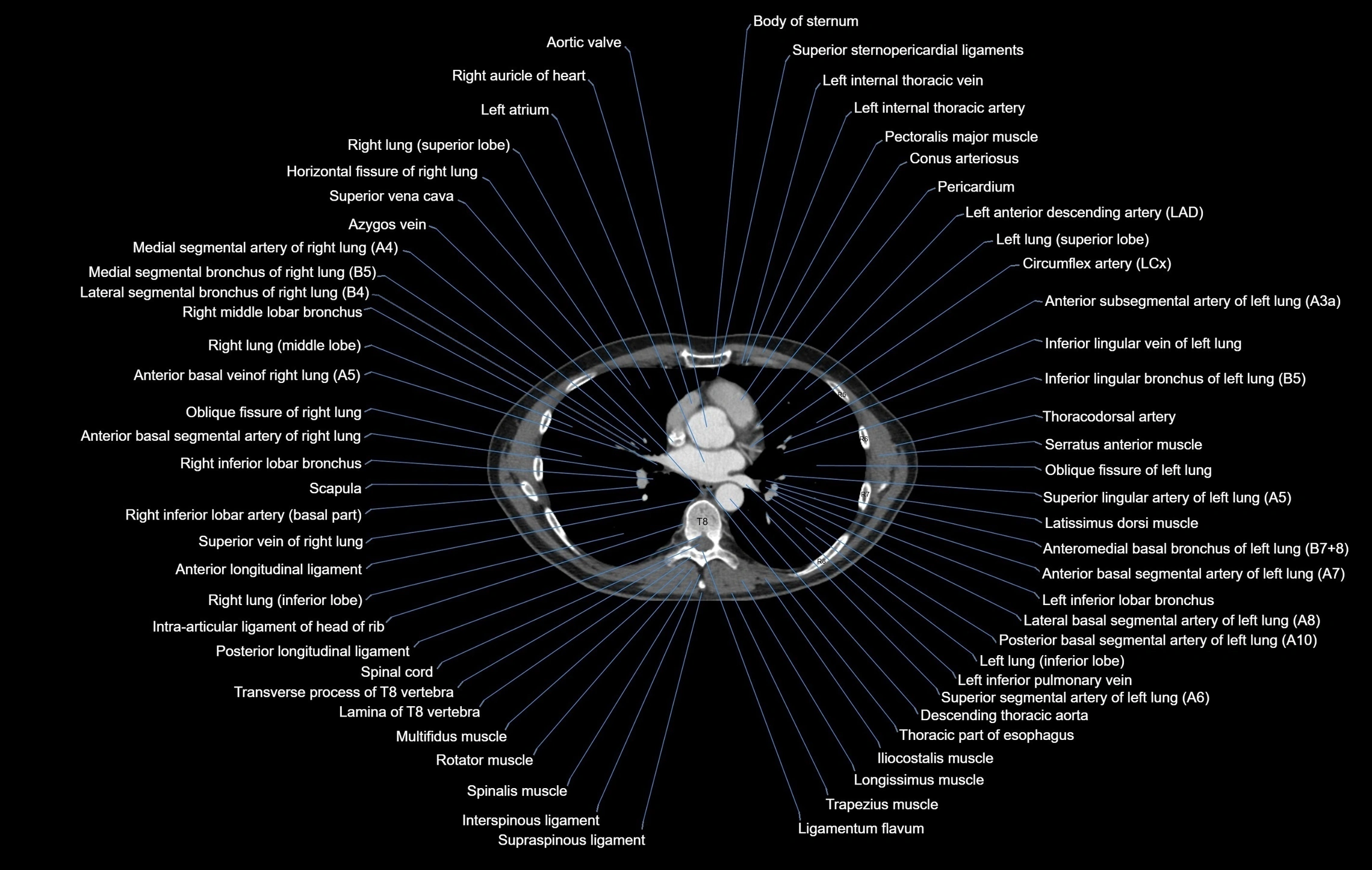 CT Chest Anatomy – Axial, Coronal & Sagittal Soft Tissue and Lung ...