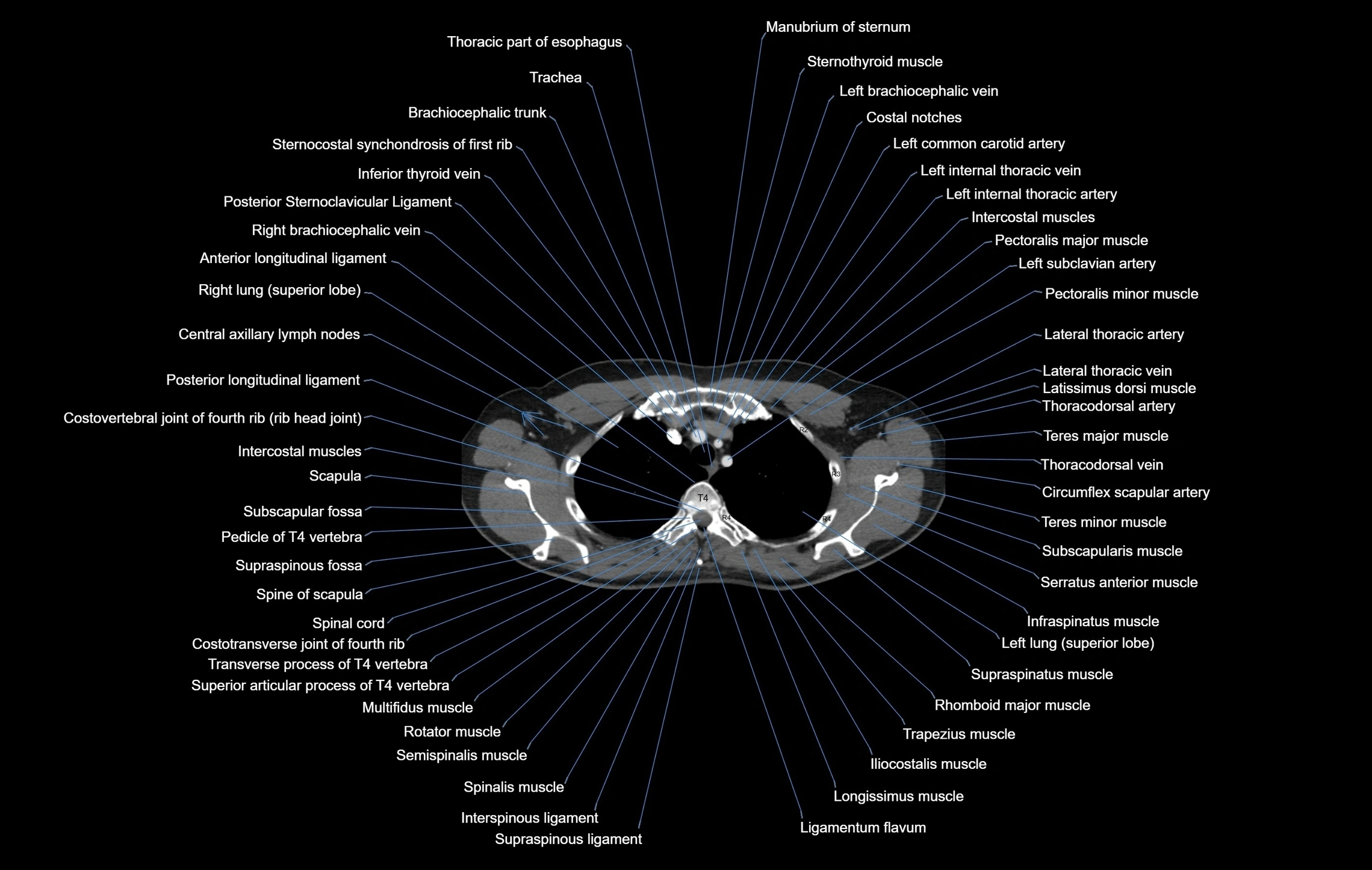 CT Chest Anatomy (Soft Tissue Window) – Labeled Axial, Coronal ...
