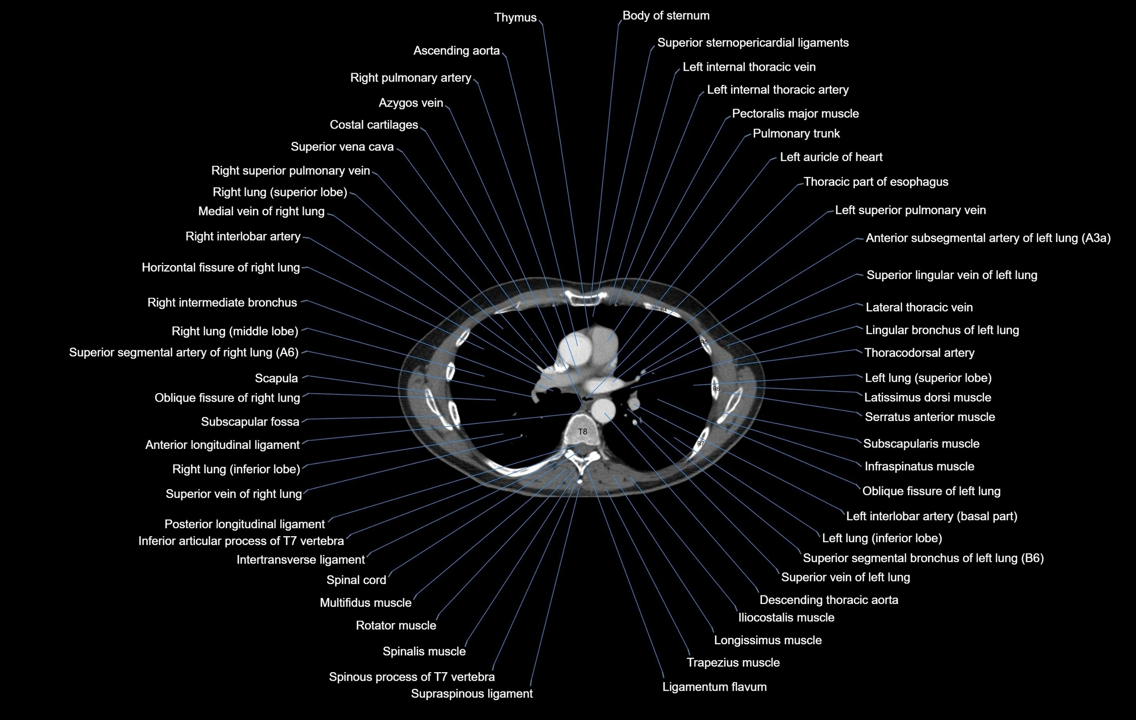 CT Chest Anatomy (Soft Tissue Window) – Labeled Axial, Coronal ...