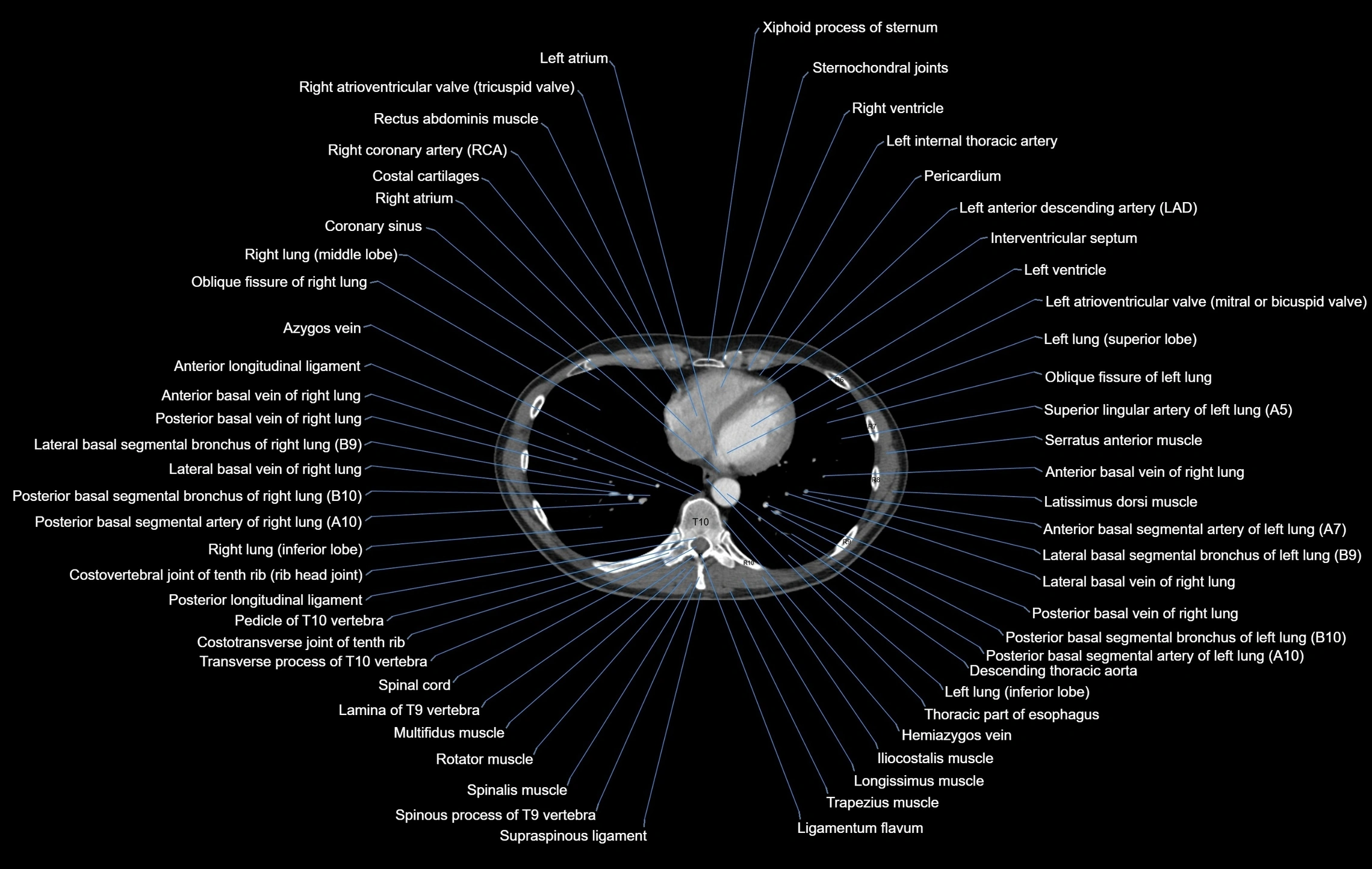 CT Chest Anatomy (Soft Tissue Window) – Labeled Axial, Coronal ...