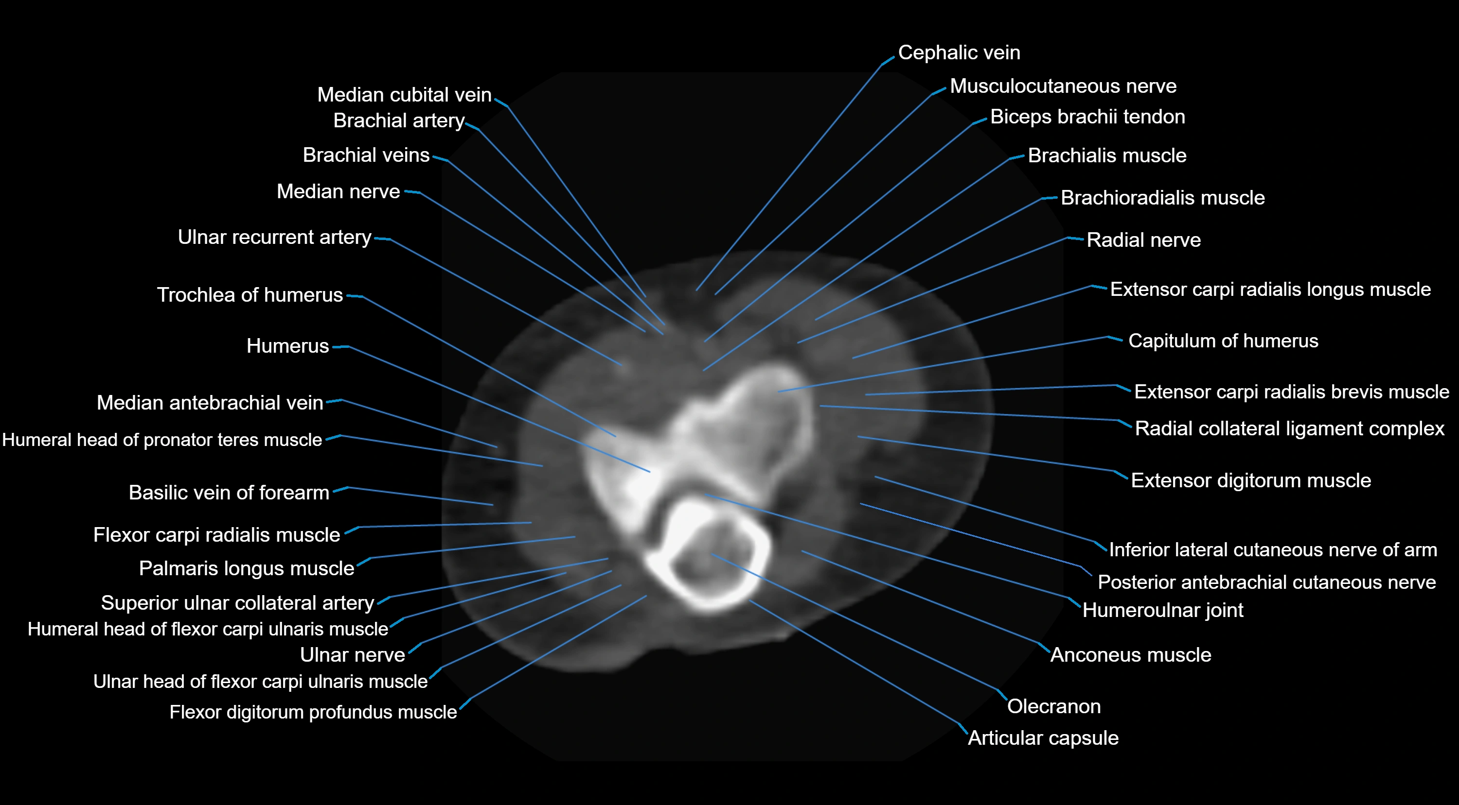 CT Elbow Anatomy – Labeled Axial, Coronal & Sagittal CT Images