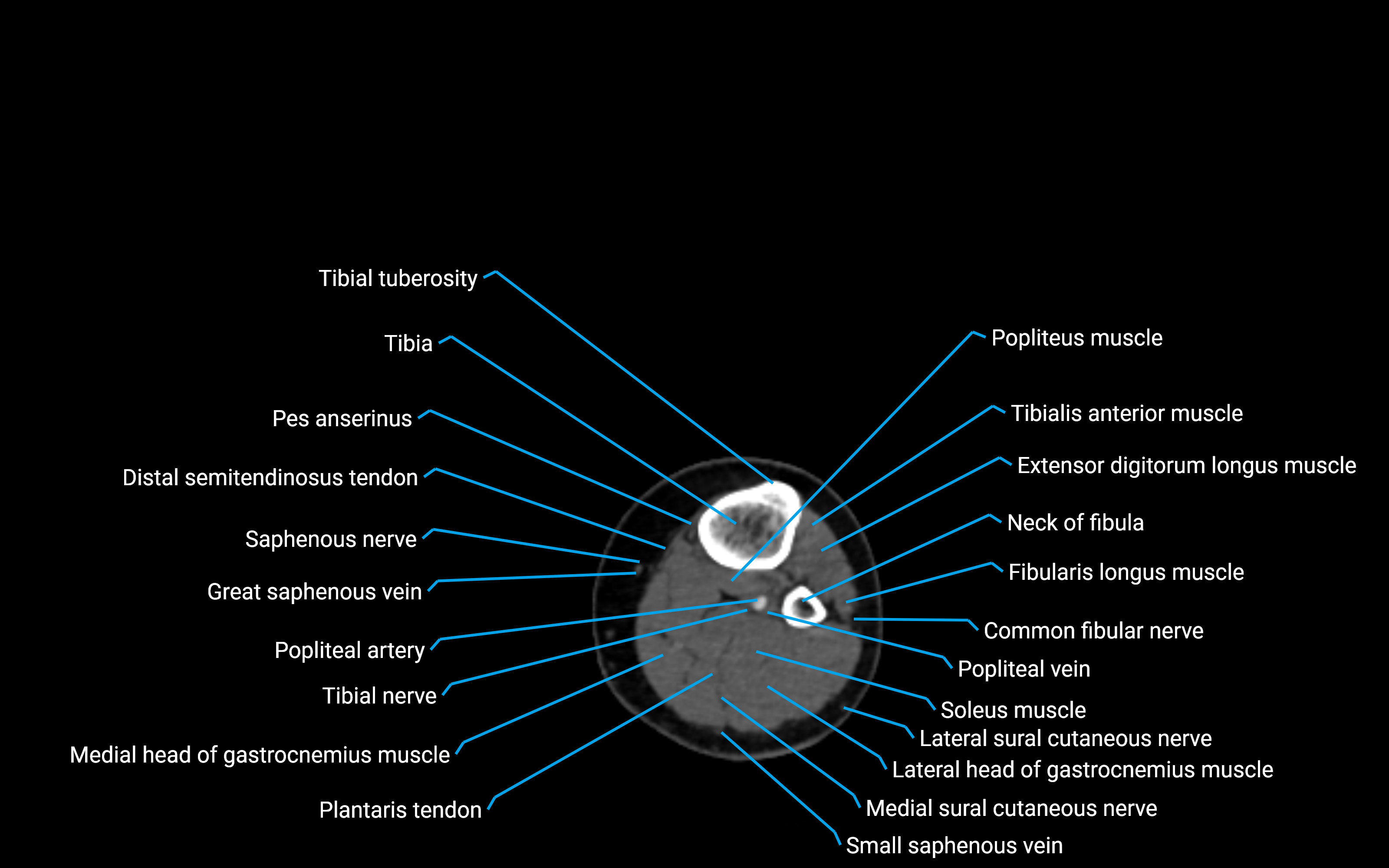CT Lower Leg Anatomy – Labeled Axial, Sagittal & Coronal Views