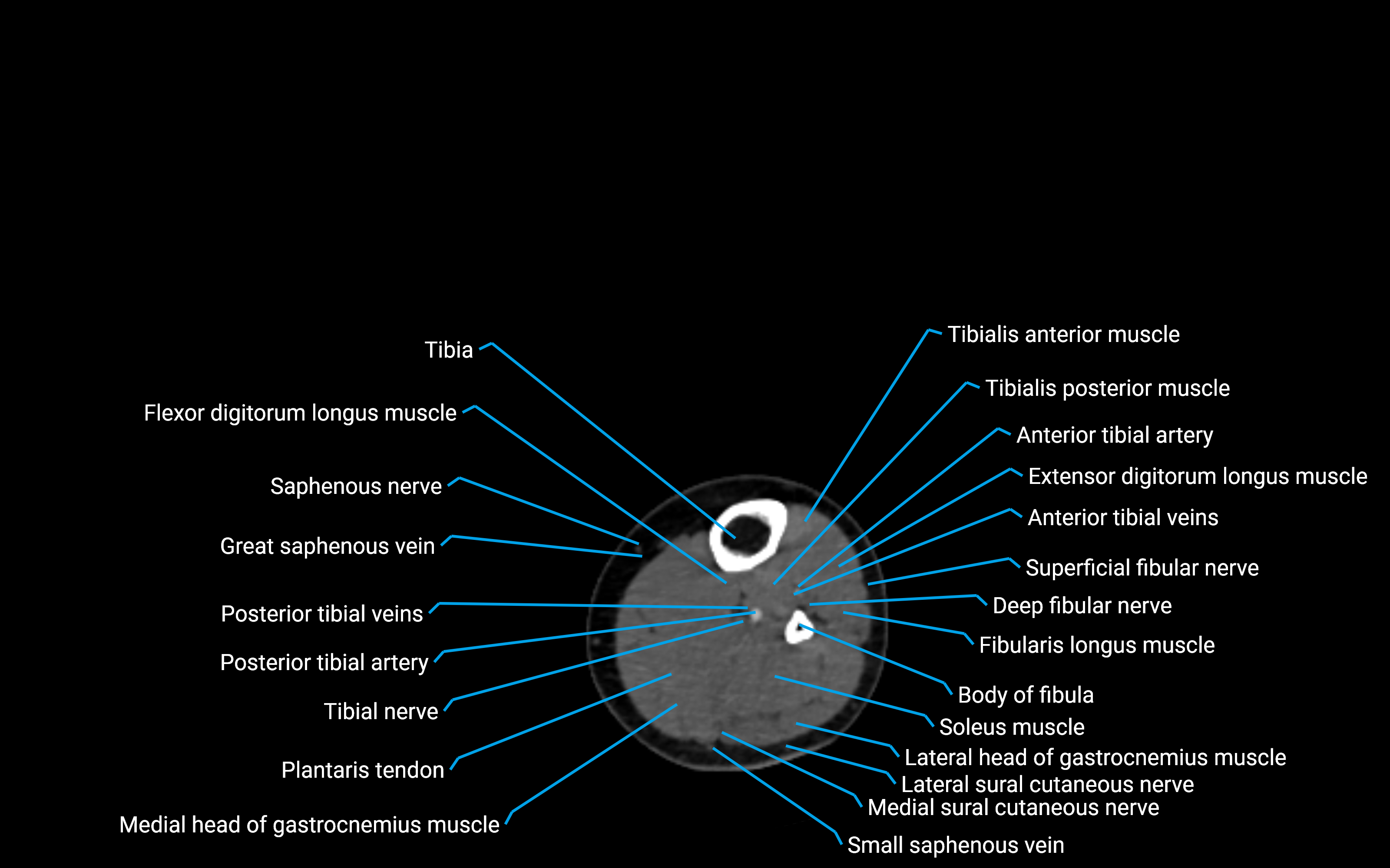 CT Lower Leg Anatomy – Labeled Axial, Sagittal & Coronal Views