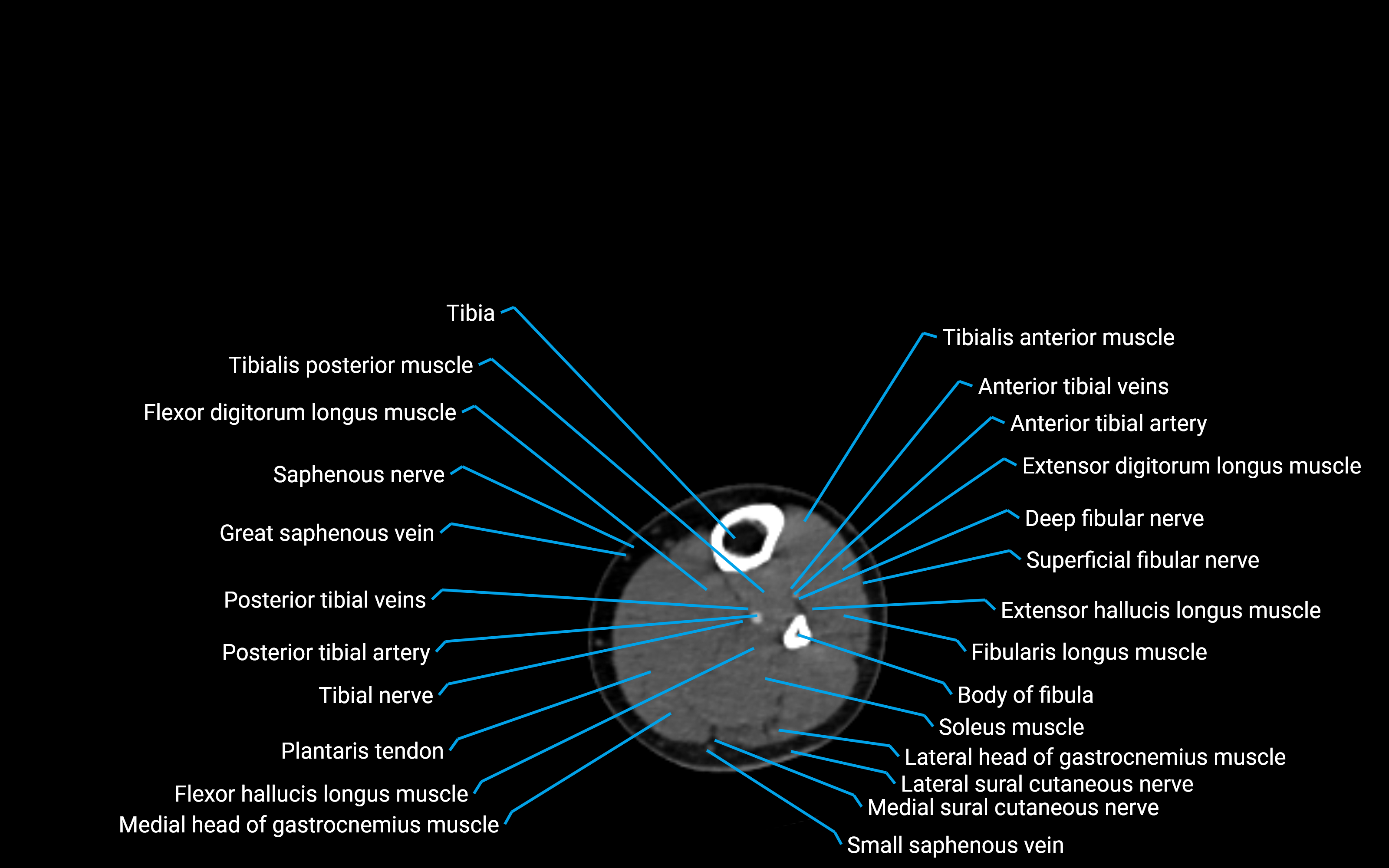 CT Lower Leg Anatomy – Labeled Axial, Sagittal & Coronal Views