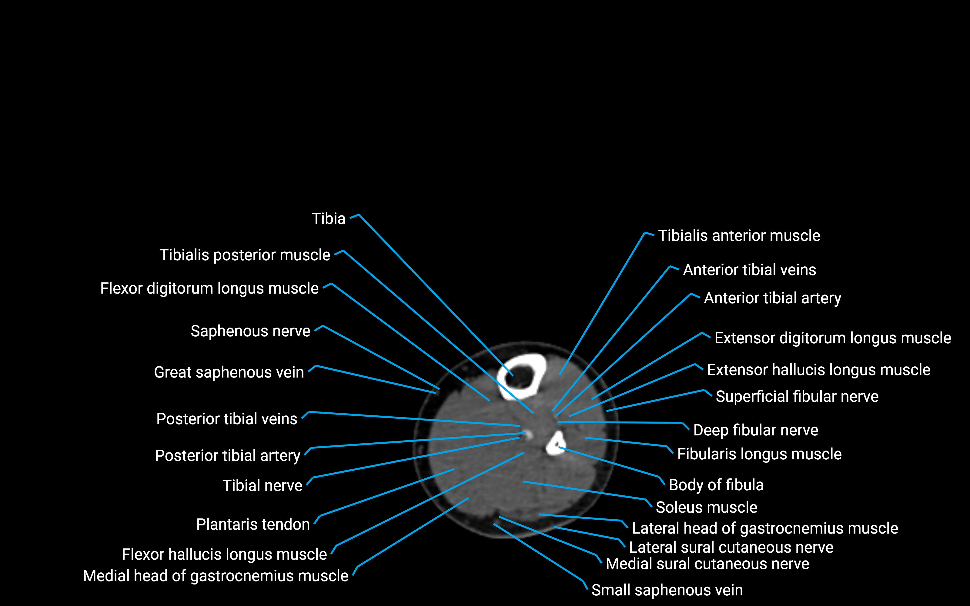 CT Lower Leg Anatomy – Labeled Axial, Sagittal & Coronal Views