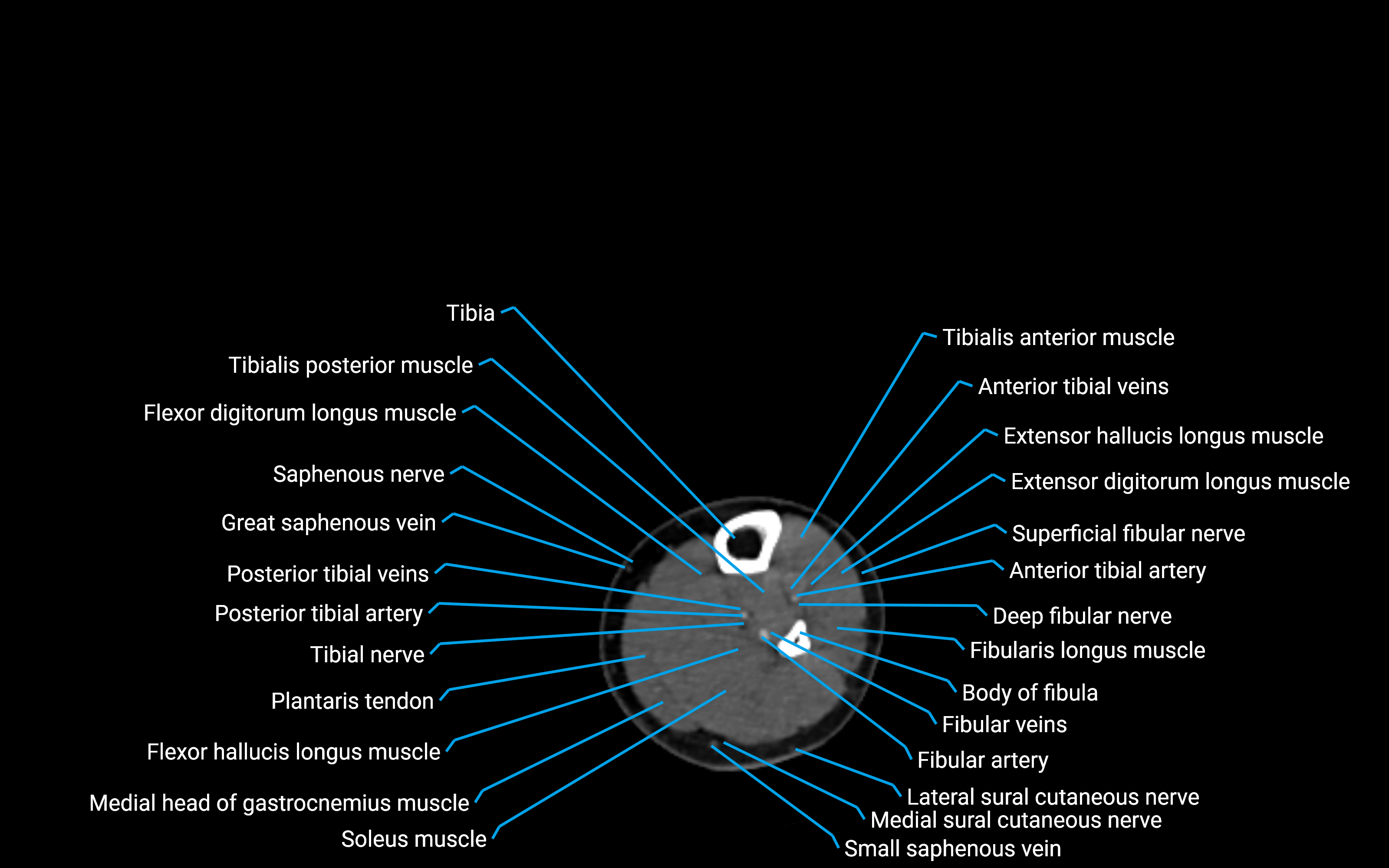 CT Lower Leg Anatomy – Labeled Axial, Sagittal & Coronal Views