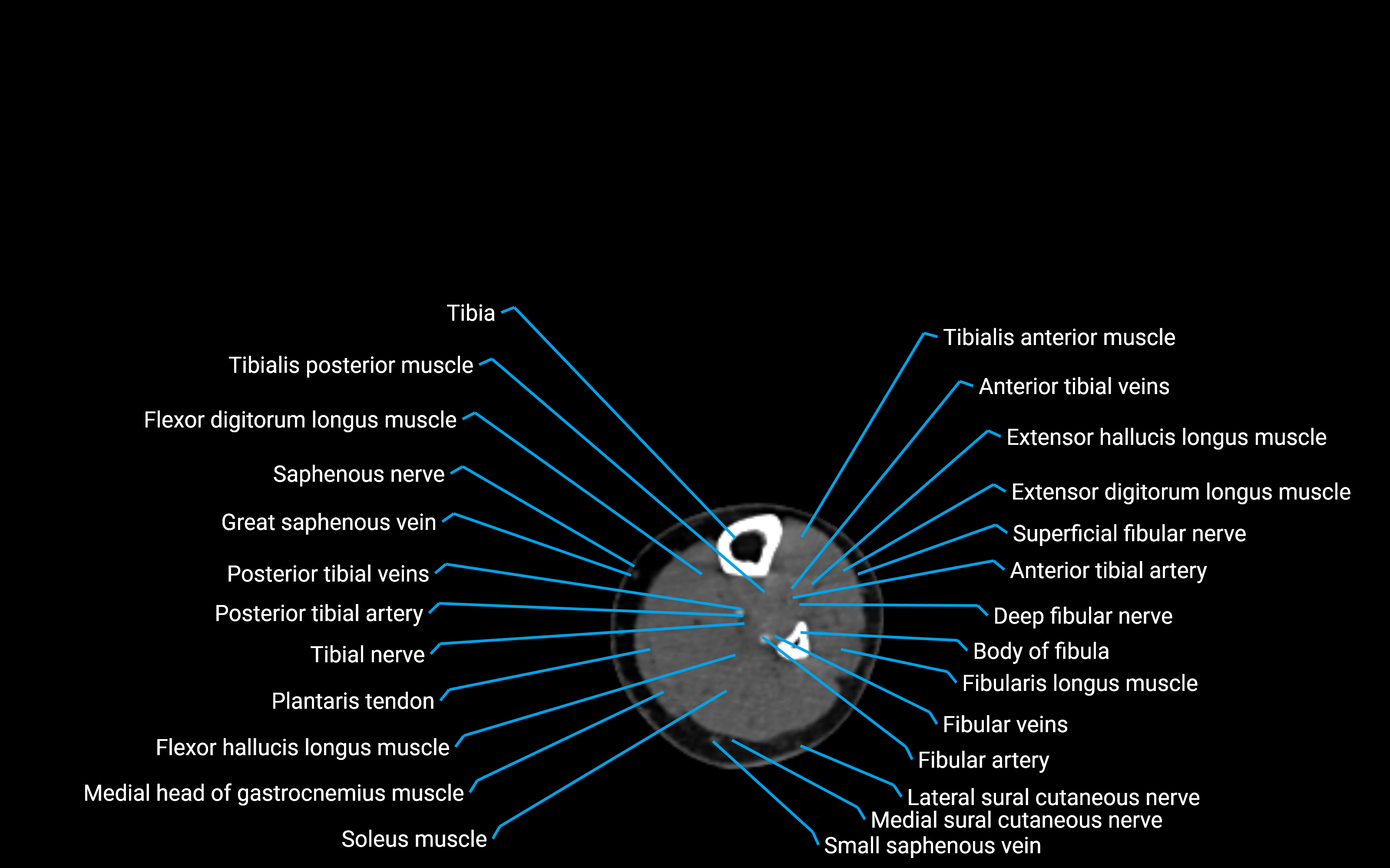 CT Lower Leg Anatomy – Labeled Axial, Sagittal & Coronal Views