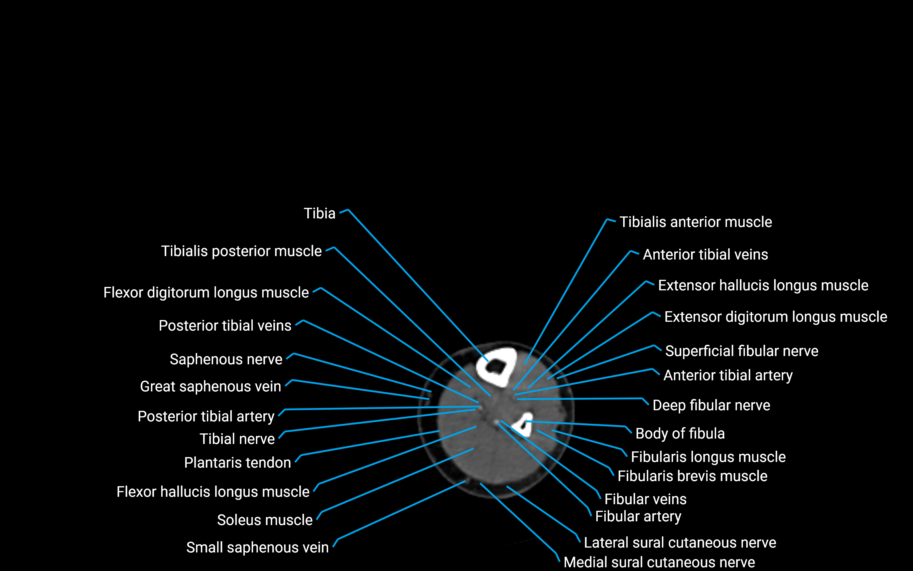 CT Lower Leg Anatomy – Labeled Axial, Sagittal & Coronal Views