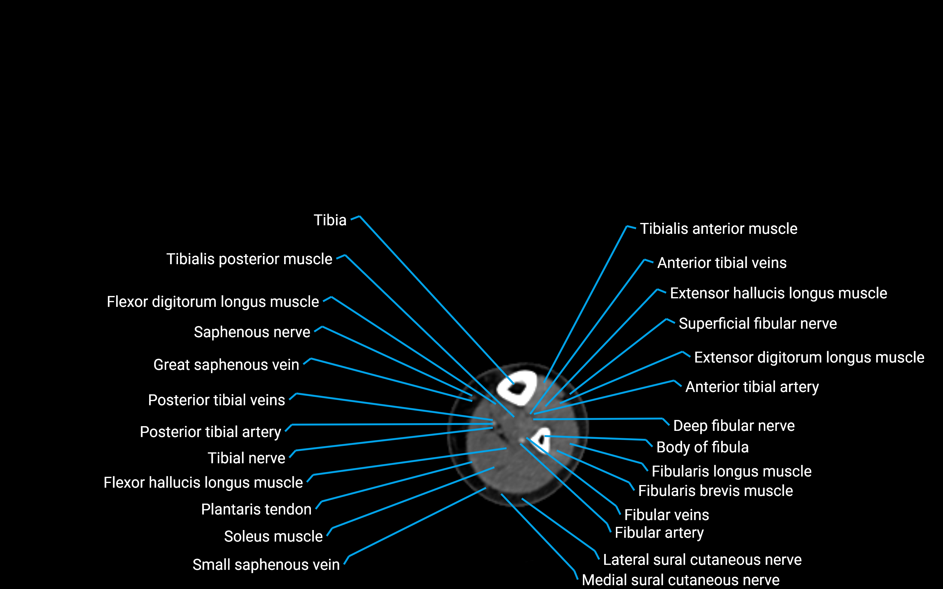 CT Lower Leg Anatomy – Labeled Axial, Sagittal & Coronal Views