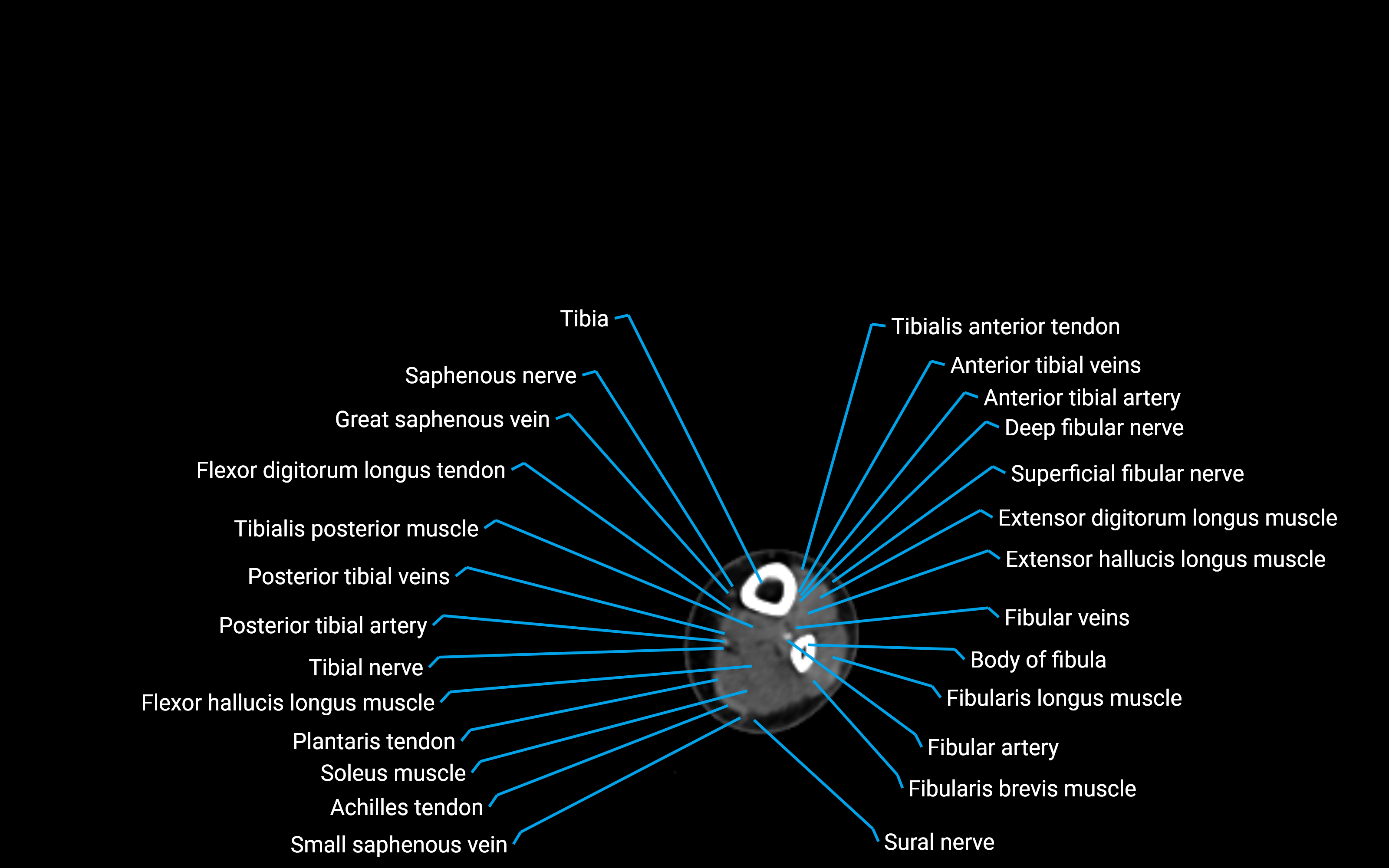 CT Lower Leg Anatomy – Labeled Axial, Sagittal & Coronal Views