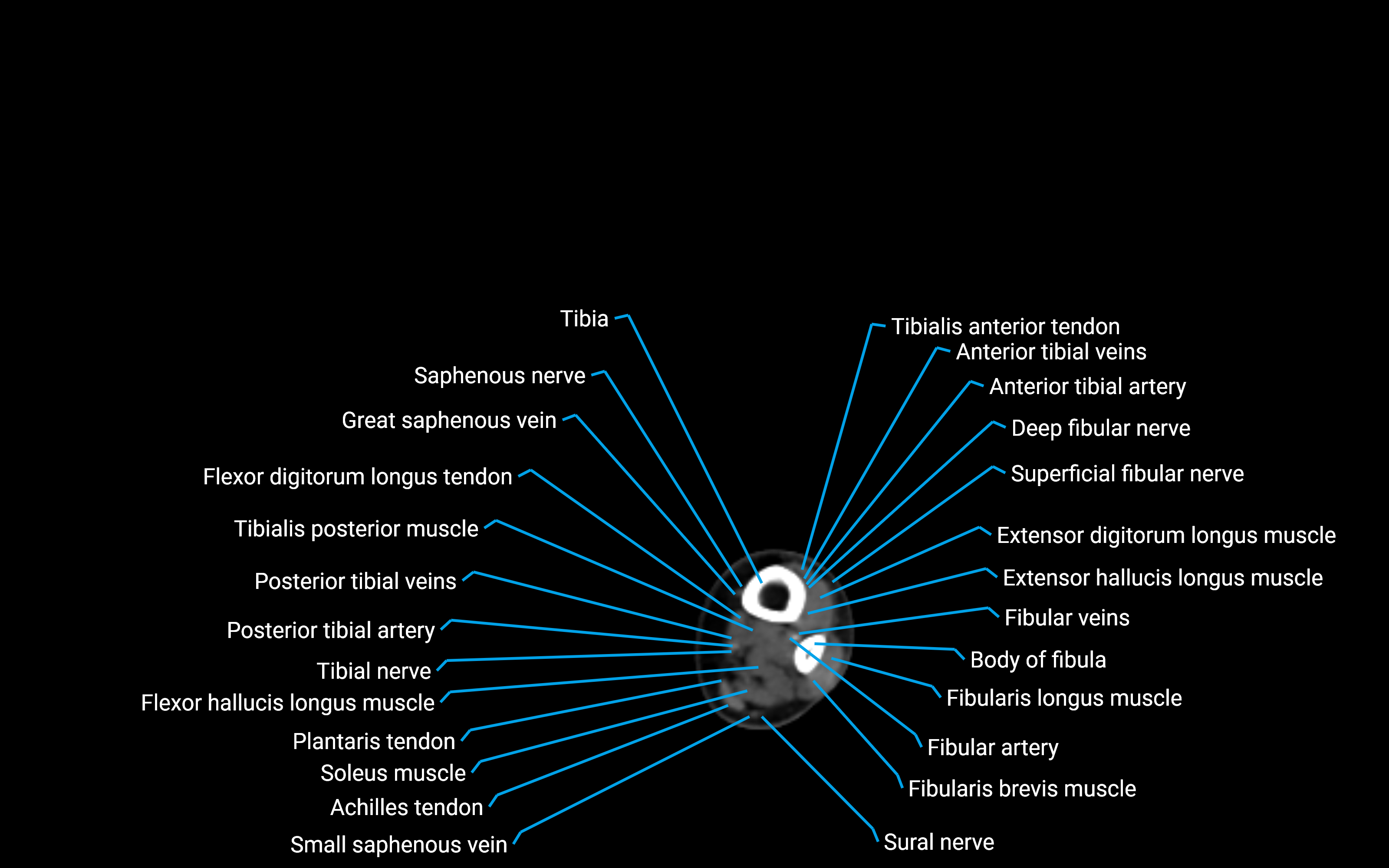 CT Lower Leg Anatomy – Labeled Axial, Sagittal & Coronal Views