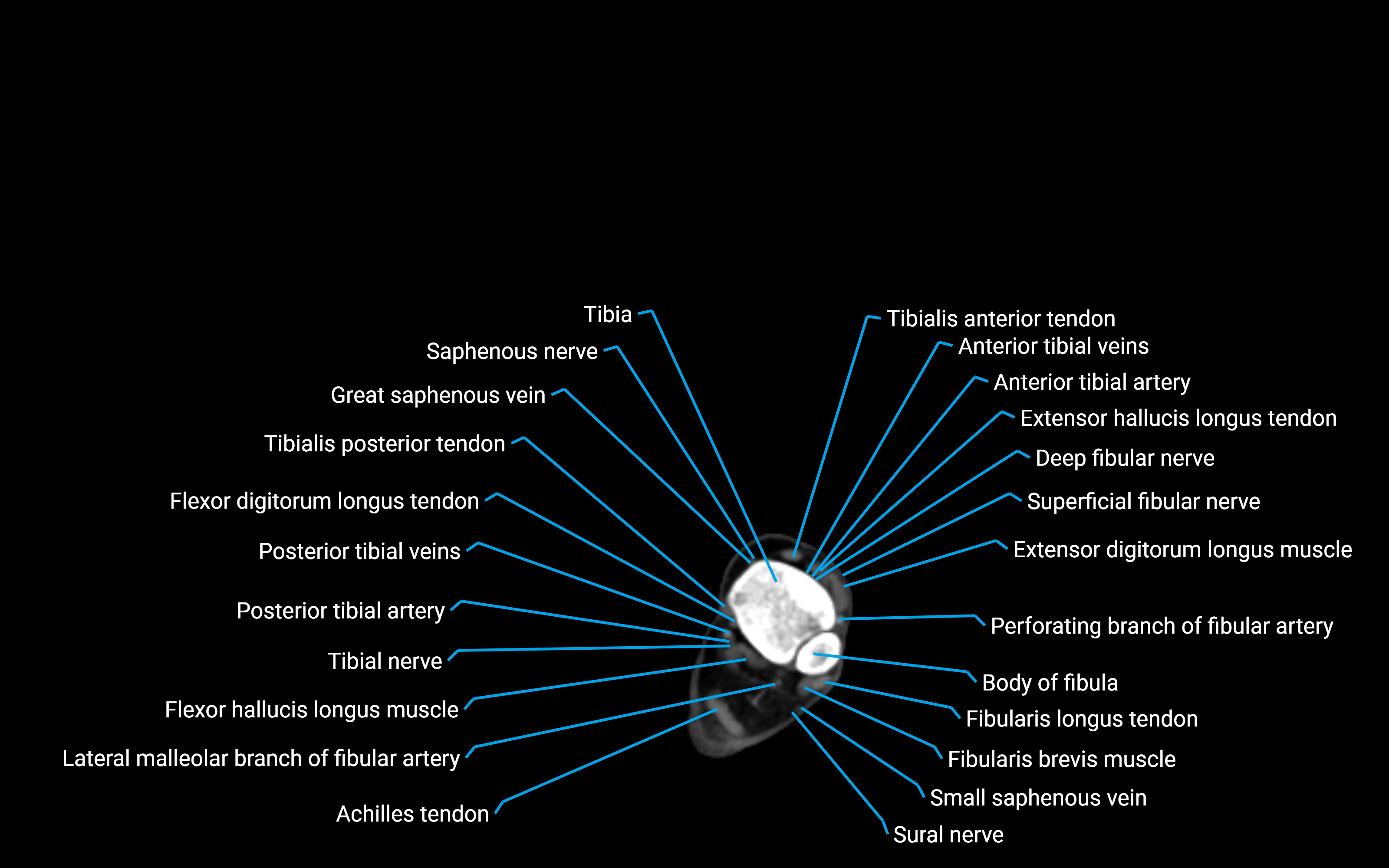 CT Lower Leg Anatomy – Labeled Axial, Sagittal & Coronal Views