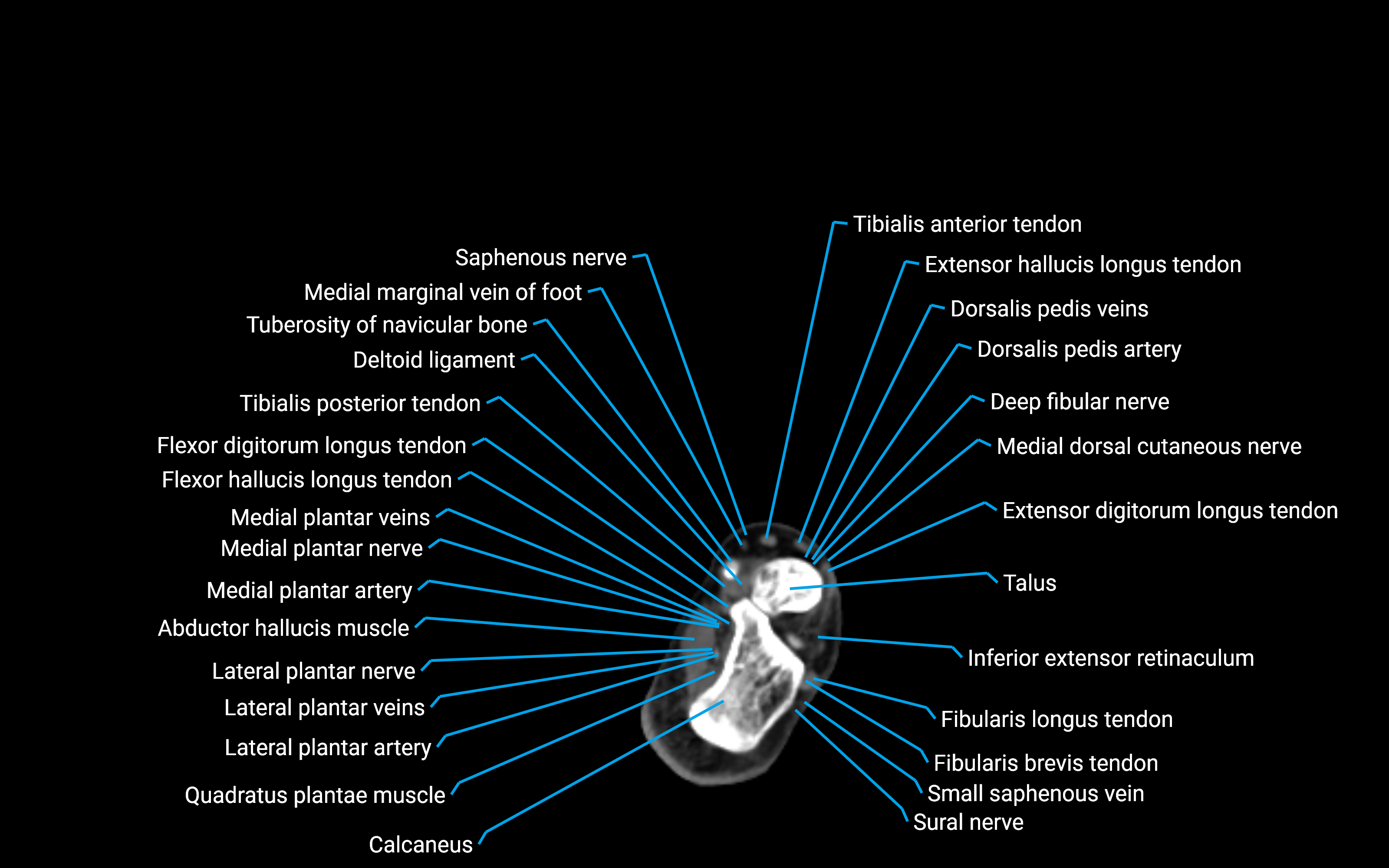 CT Lower Leg Anatomy – Labeled Axial, Sagittal & Coronal Views
