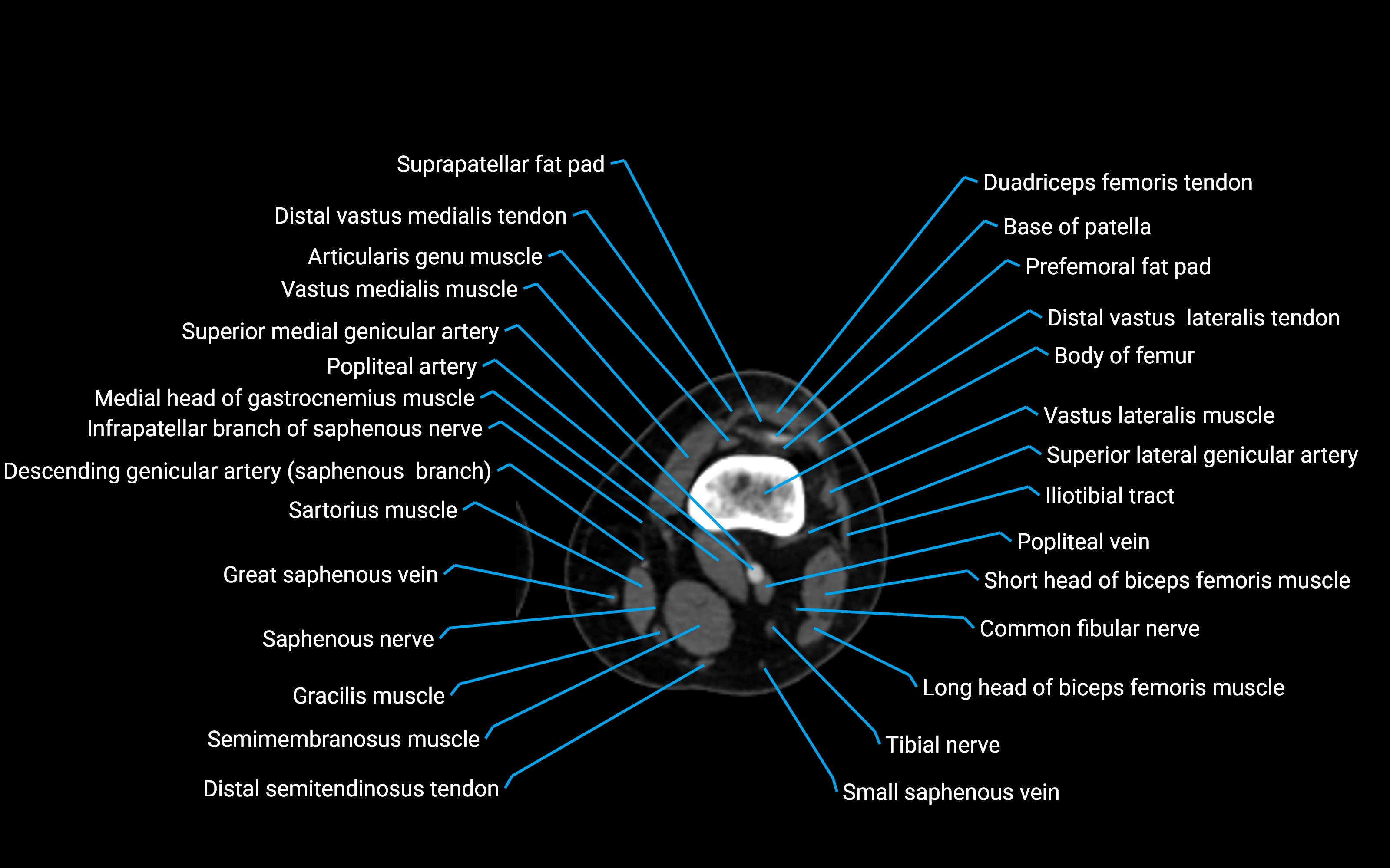 CT Lower Leg Anatomy – Labeled Axial, Sagittal & Coronal Views