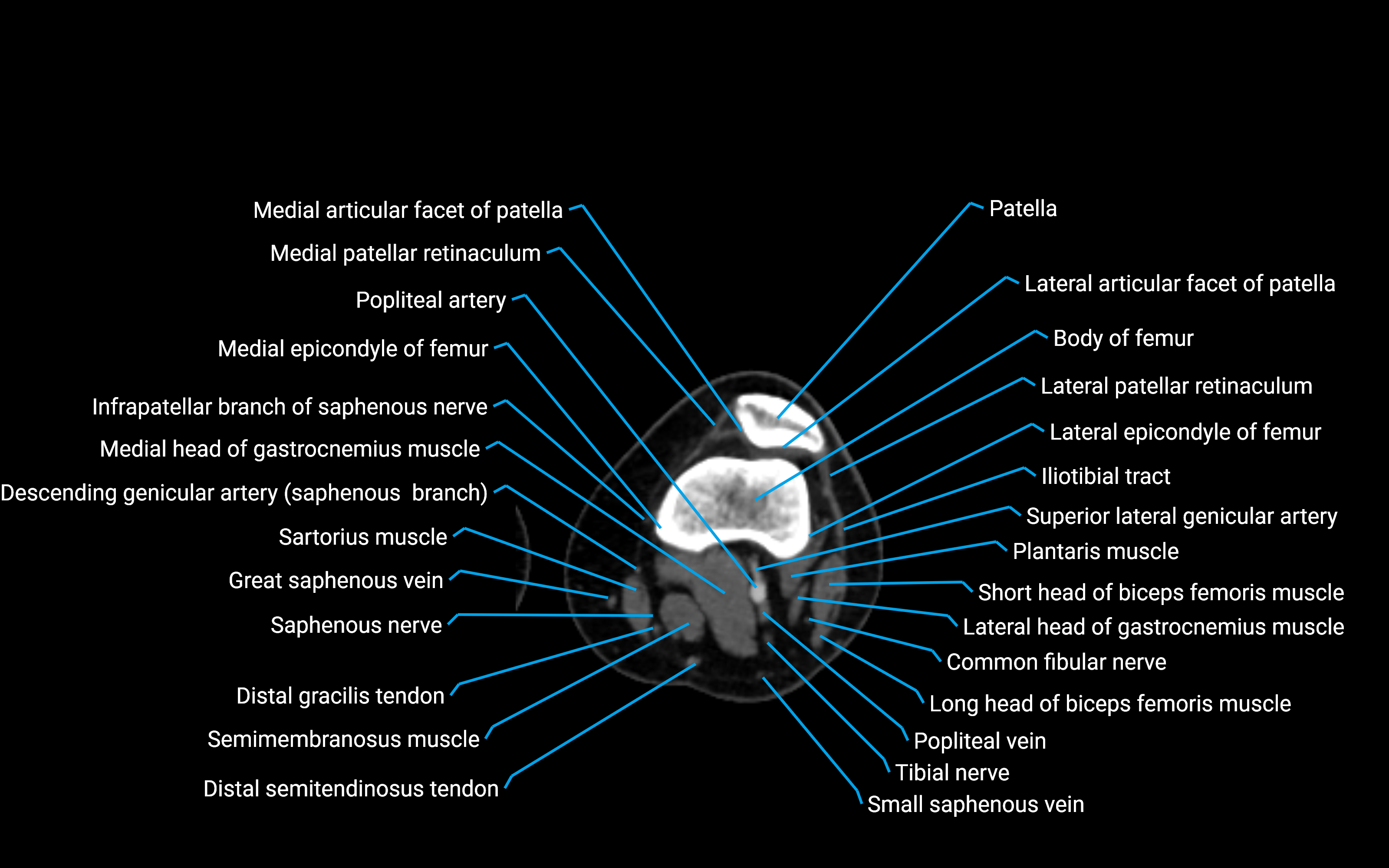 CT Lower Leg Anatomy – Labeled Axial, Sagittal & Coronal Views
