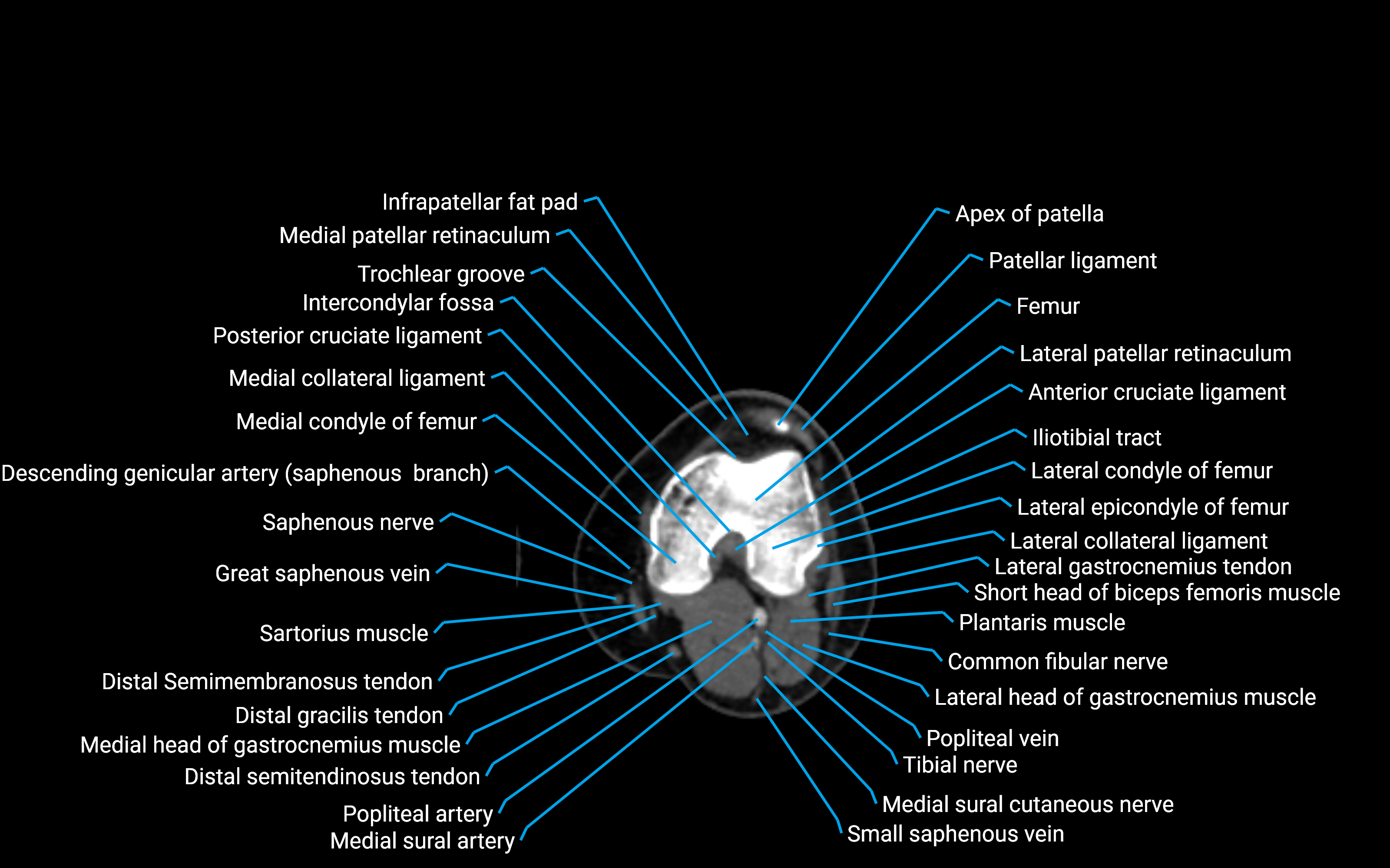 CT Lower Leg Anatomy – Labeled Axial, Sagittal & Coronal Views