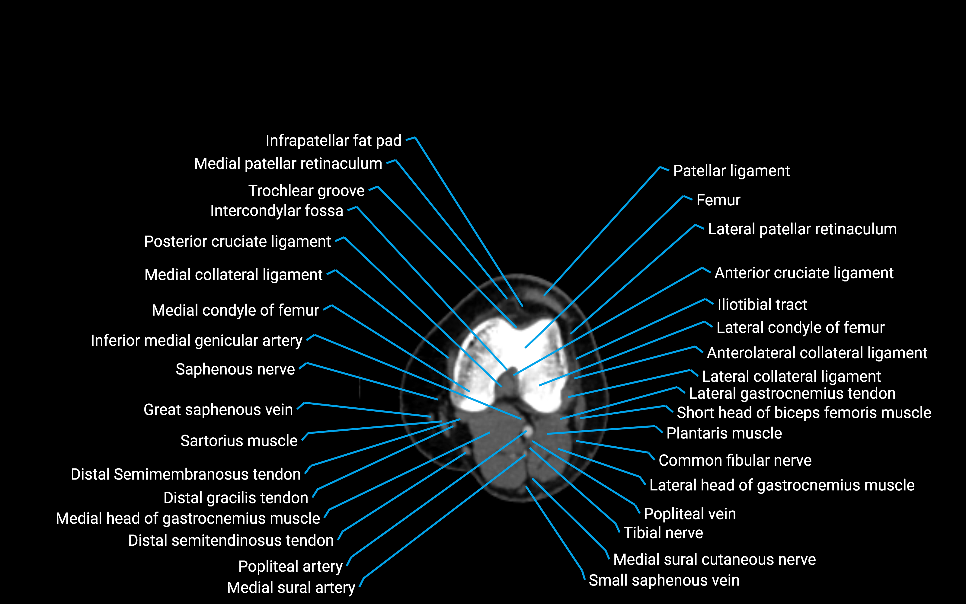 CT Lower Leg Anatomy – Labeled Axial, Sagittal & Coronal Views