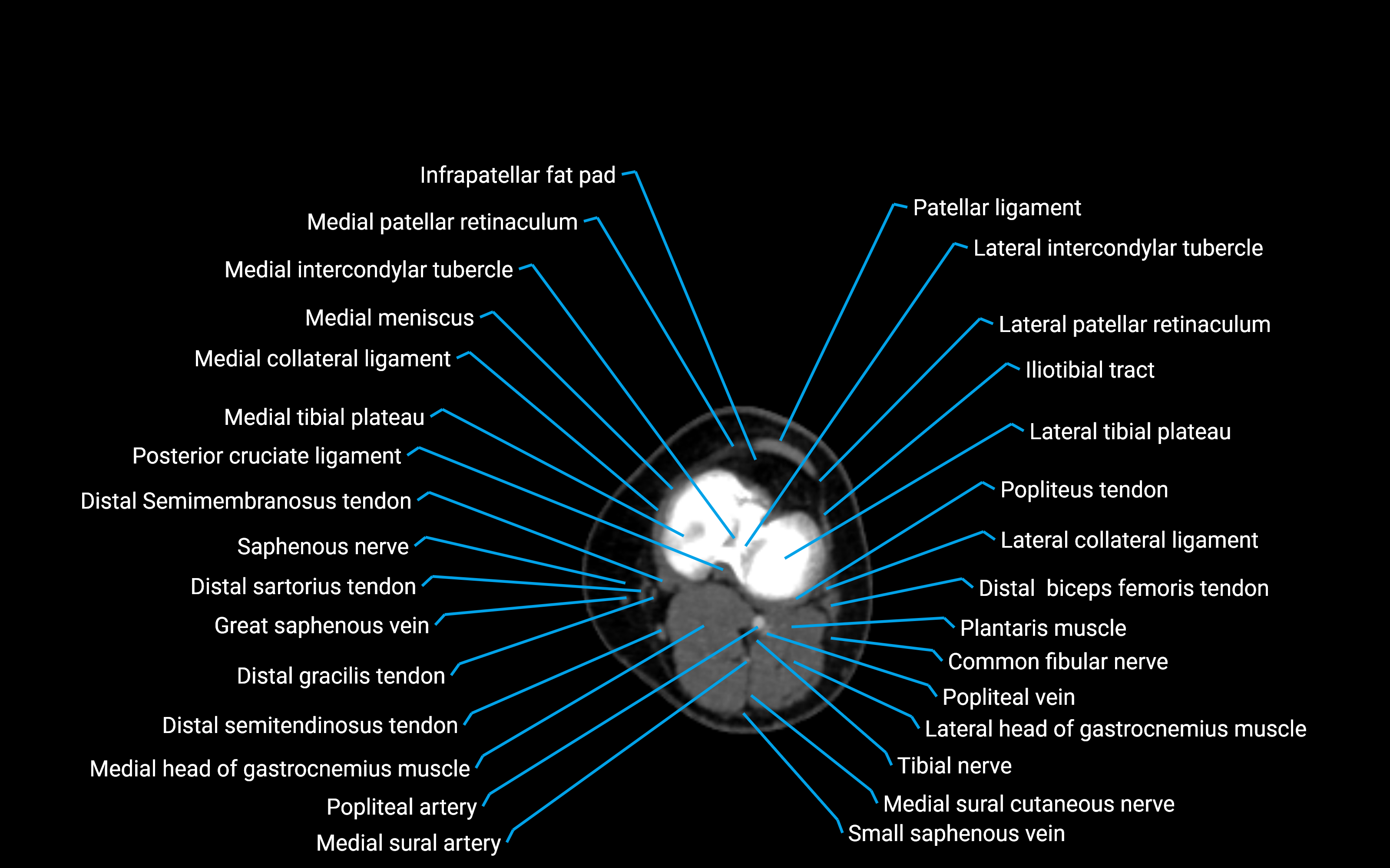 CT Lower Leg Anatomy – Labeled Axial, Sagittal & Coronal Views