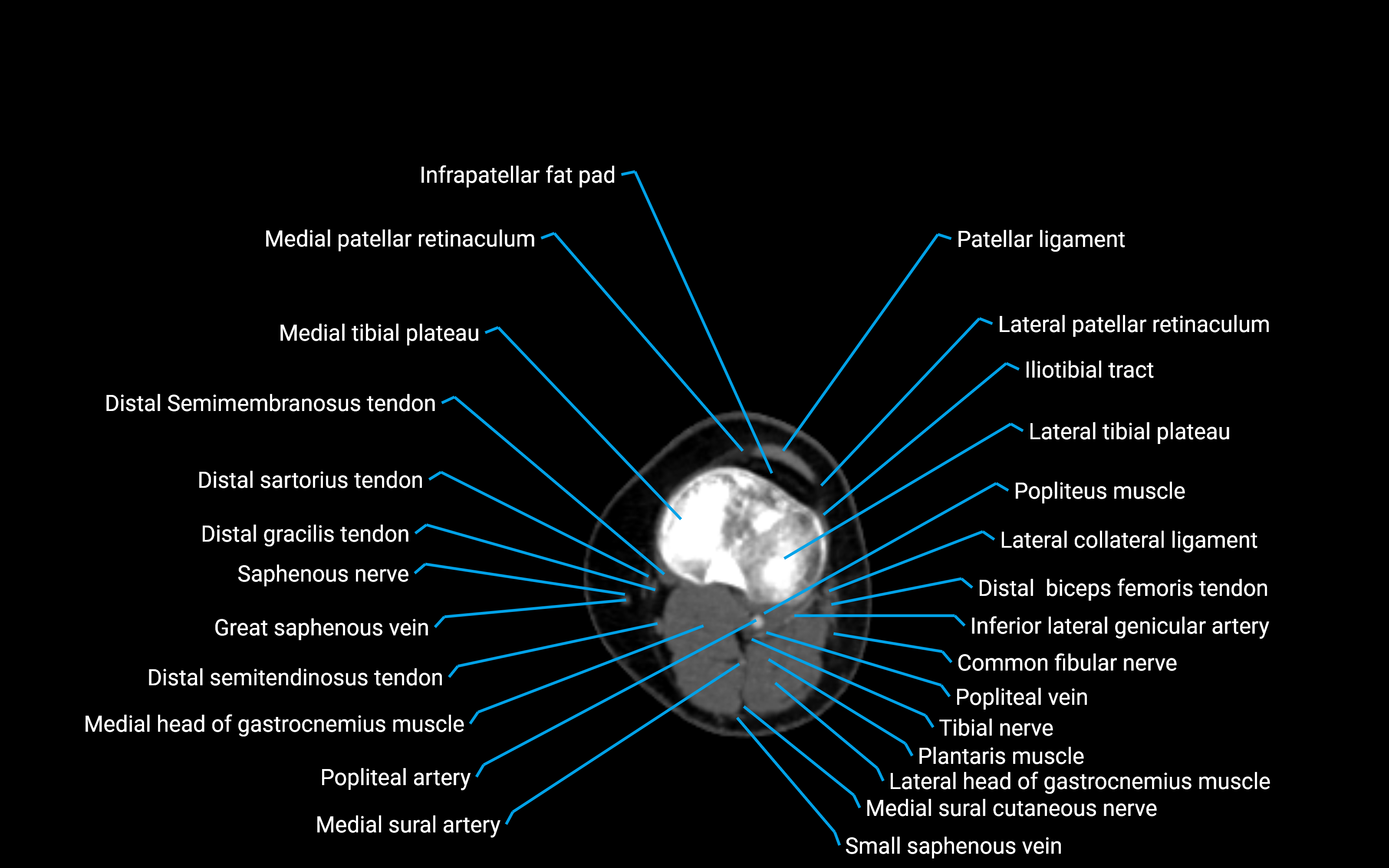 CT Lower Leg Anatomy – Labeled Axial, Sagittal & Coronal Views