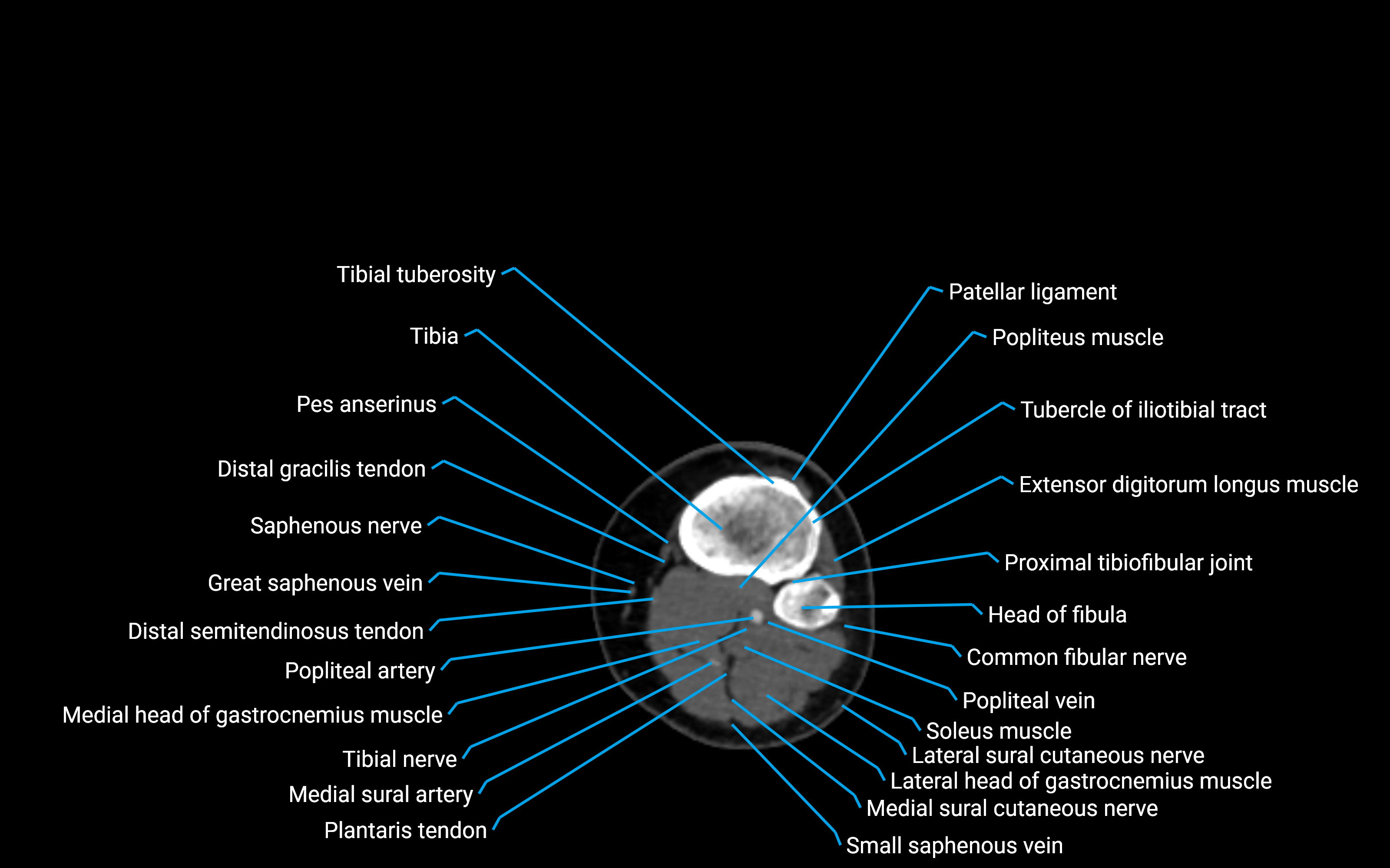 CT Lower Leg Anatomy – Labeled Axial, Sagittal & Coronal Views