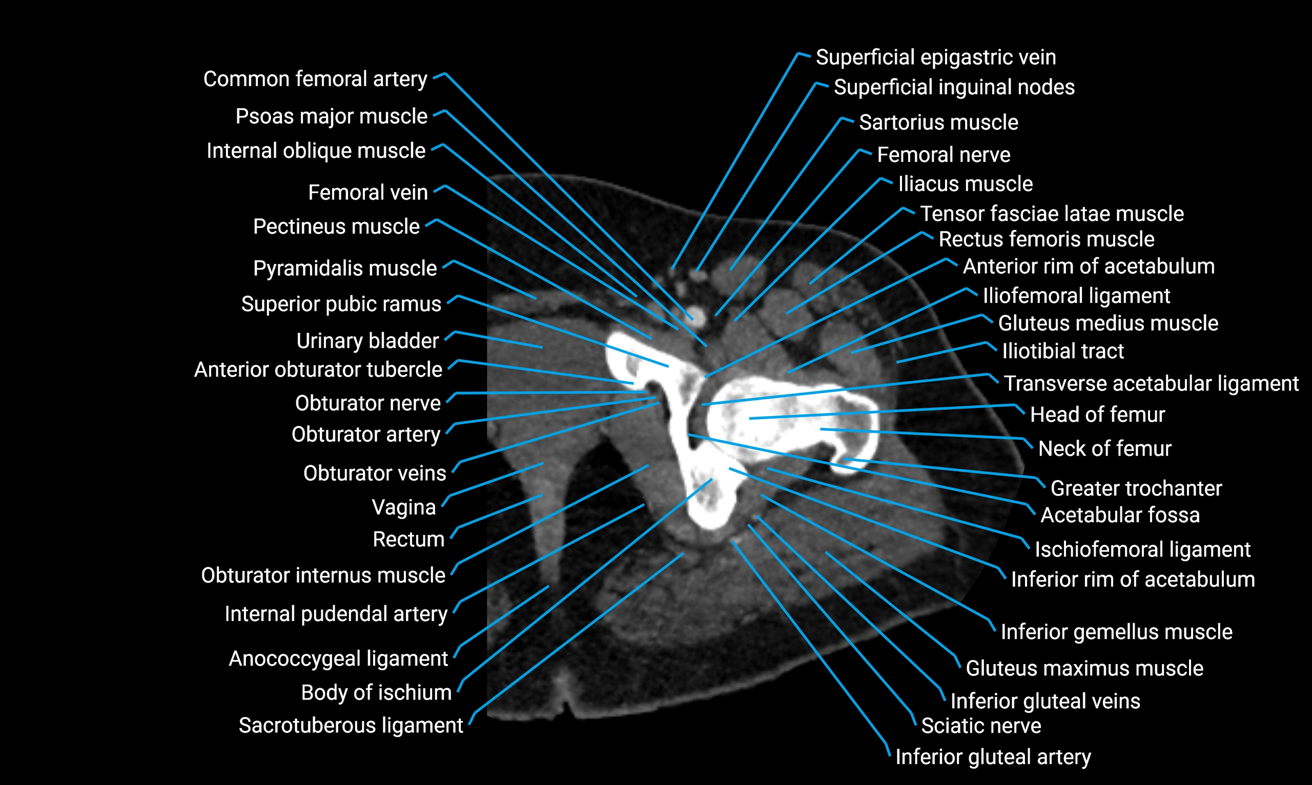 CT Lower Limb Anatomy – Normal Labeled CT Axial, Coronal, Sagittal ...