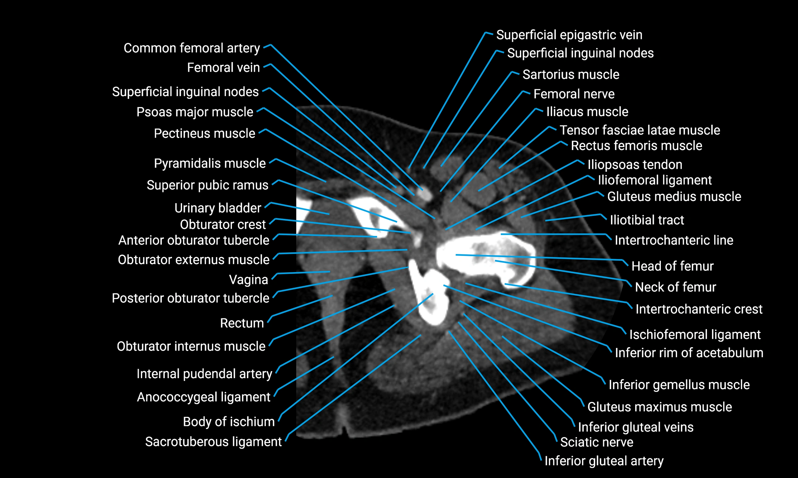 CT Lower Limb Anatomy – Normal Labeled CT Axial, Coronal, Sagittal ...