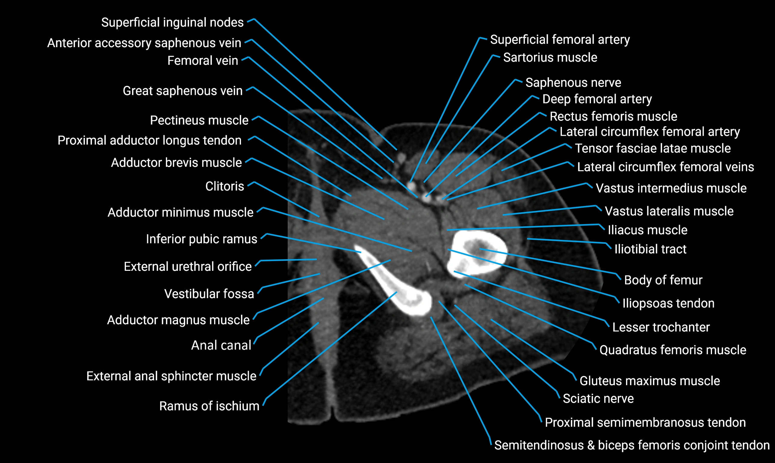 CT Lower Limb Anatomy – Normal Labeled CT Axial, Coronal, Sagittal ...