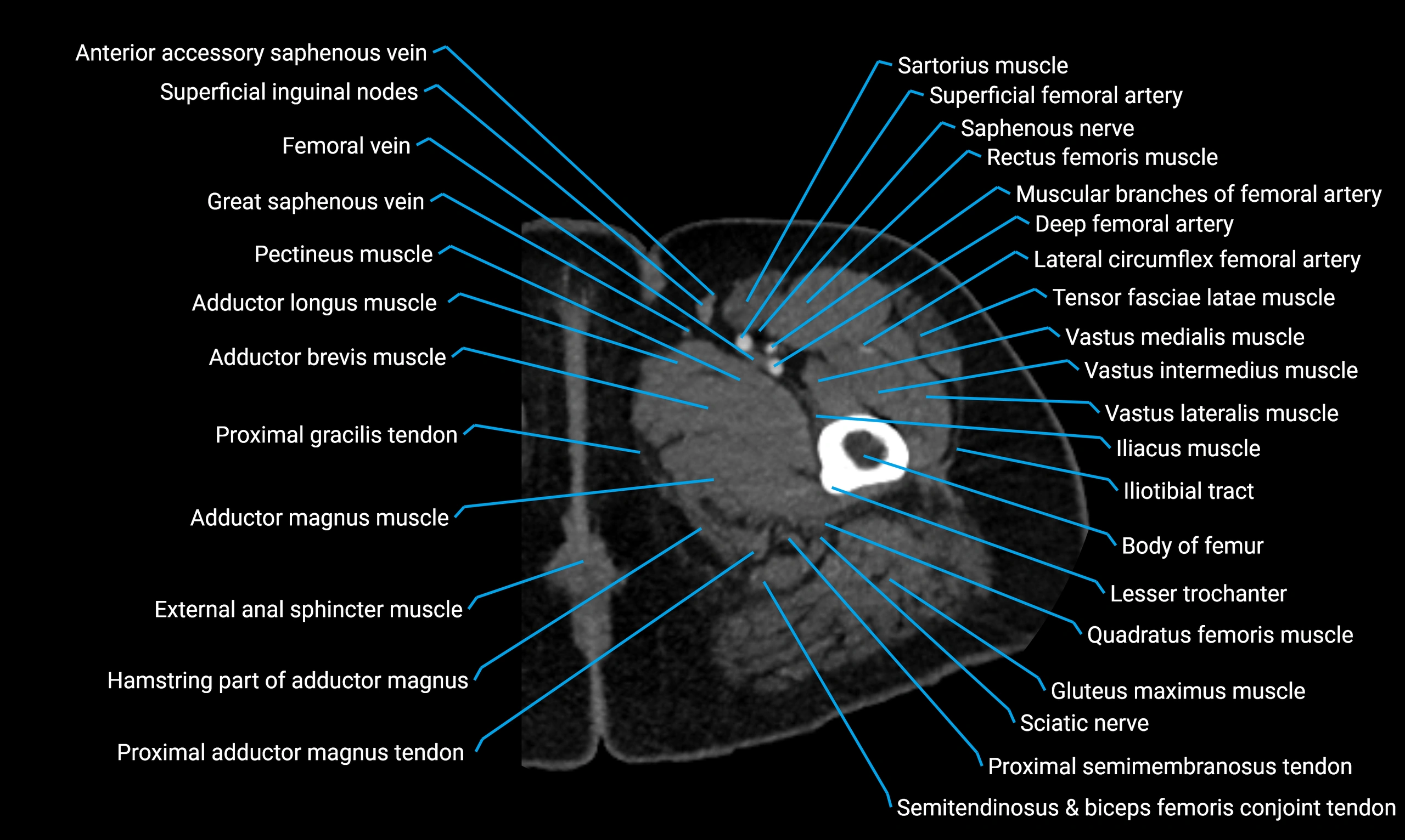 CT Lower Limb Anatomy – Normal Labeled CT Axial, Coronal, Sagittal ...