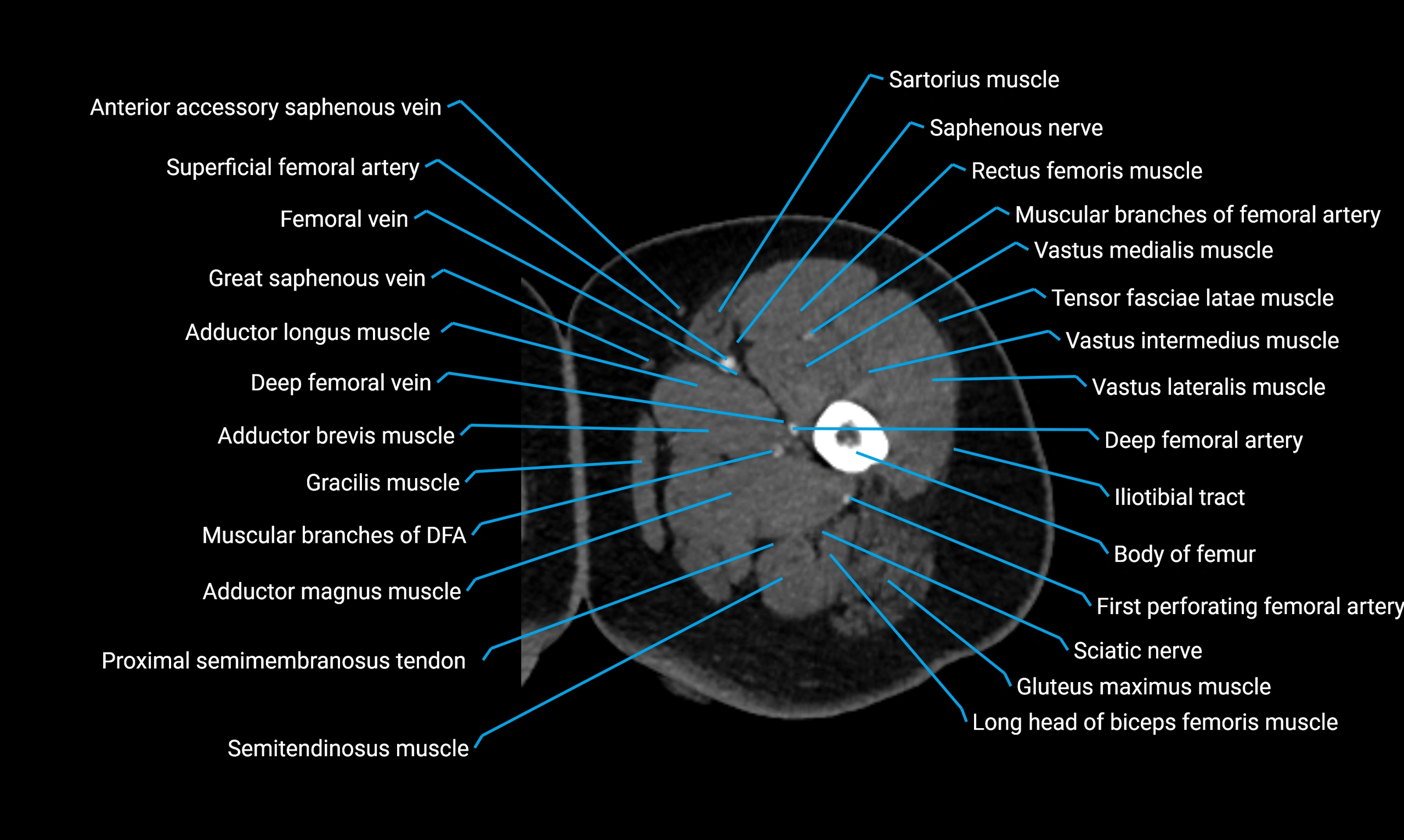 CT Lower Limb Anatomy – Normal Labeled CT Axial, Coronal, Sagittal ...