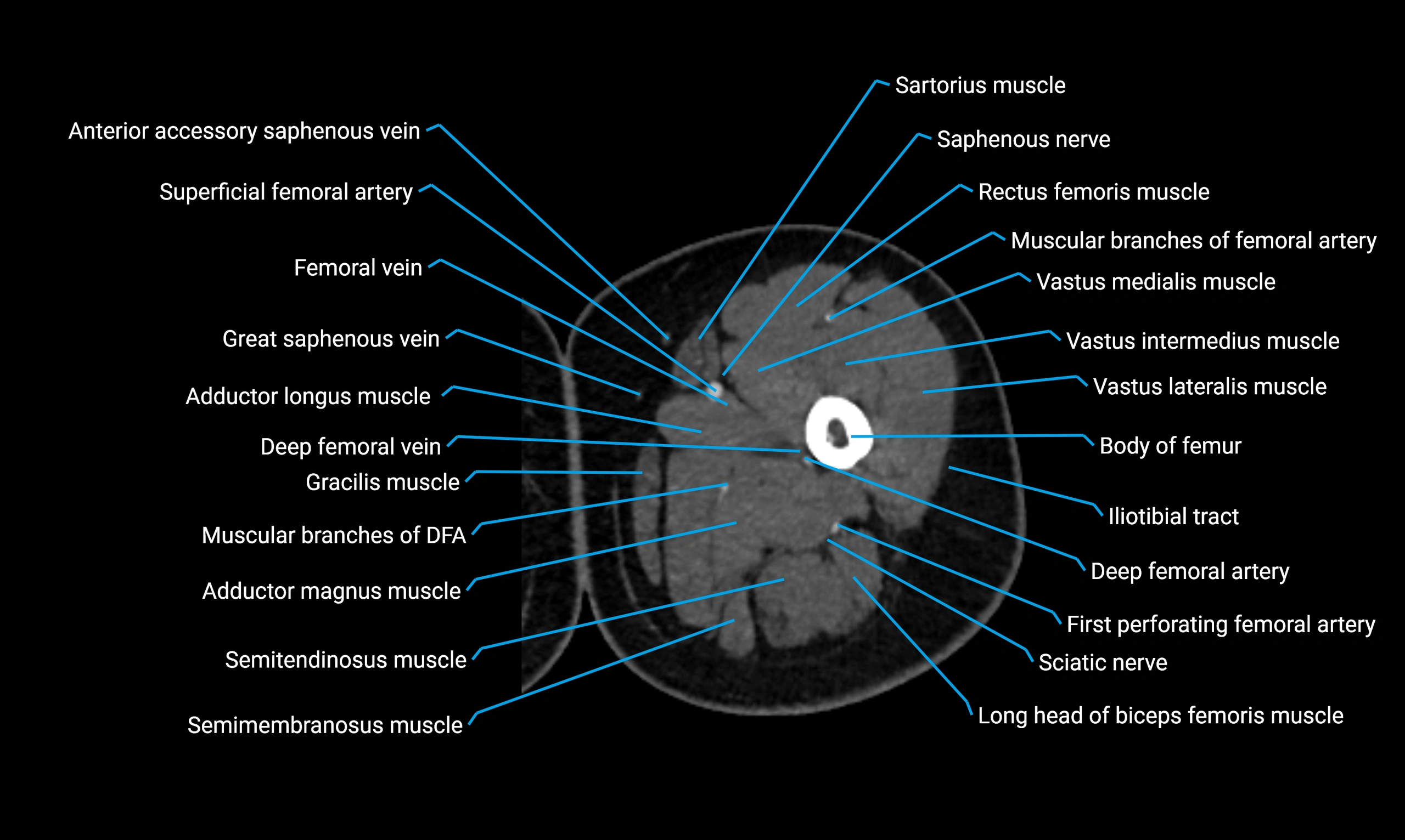 CT Lower Limb Anatomy – Normal Labeled CT Axial, Coronal, Sagittal ...