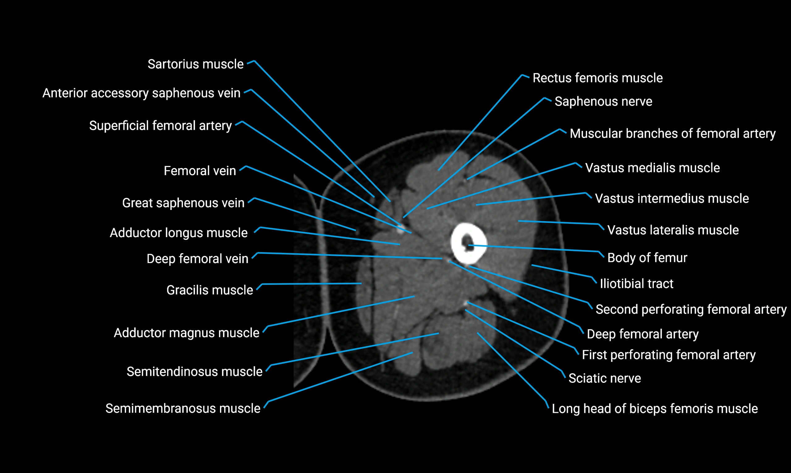 CT Lower Limb Anatomy – Normal Labeled CT Axial, Coronal, Sagittal ...