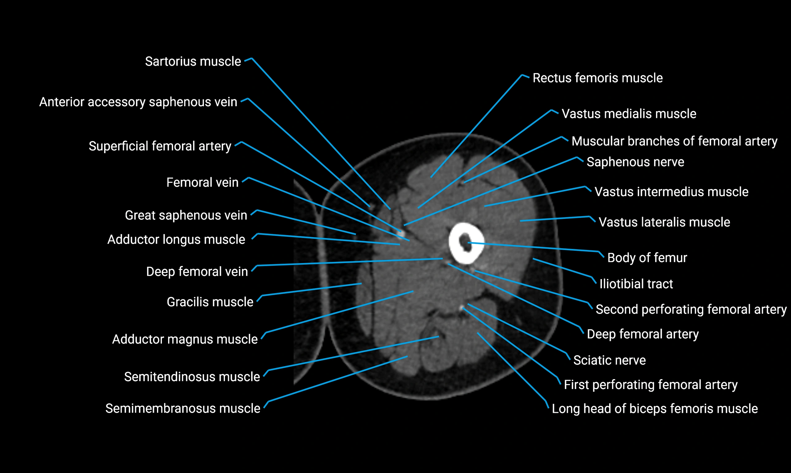 CT Lower Limb Anatomy – Normal Labeled CT Axial, Coronal, Sagittal ...