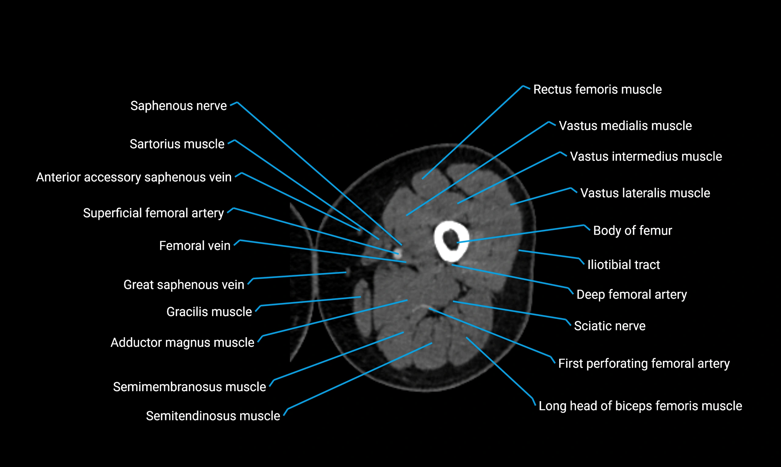 CT Lower Limb Anatomy – Normal Labeled CT Axial, Coronal, Sagittal ...