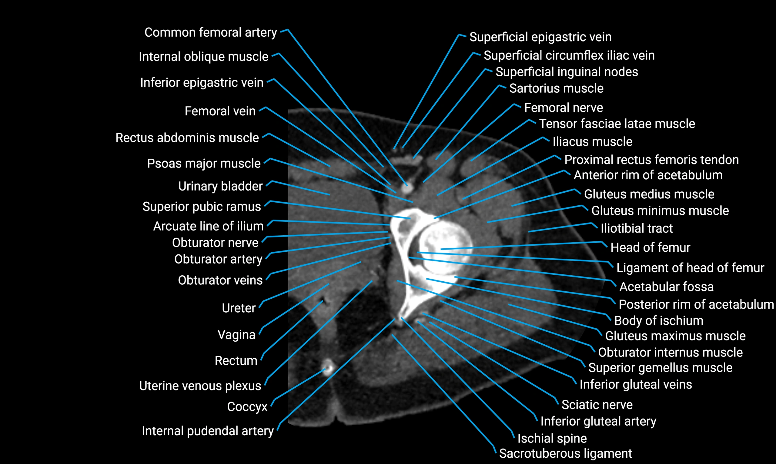 CT Lower Limb Anatomy – Normal Labeled CT Axial, Coronal, Sagittal ...
