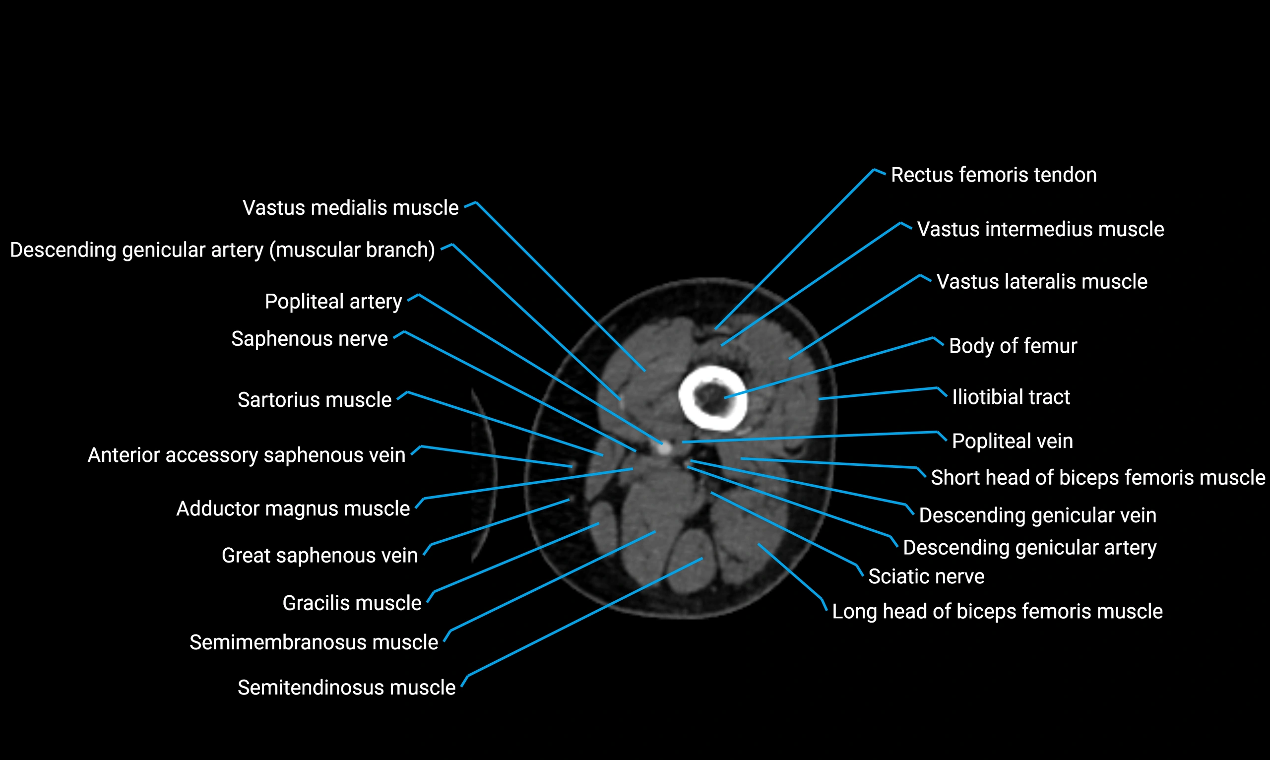 CT Lower Limb Anatomy – Normal Labeled CT Axial, Coronal, Sagittal ...