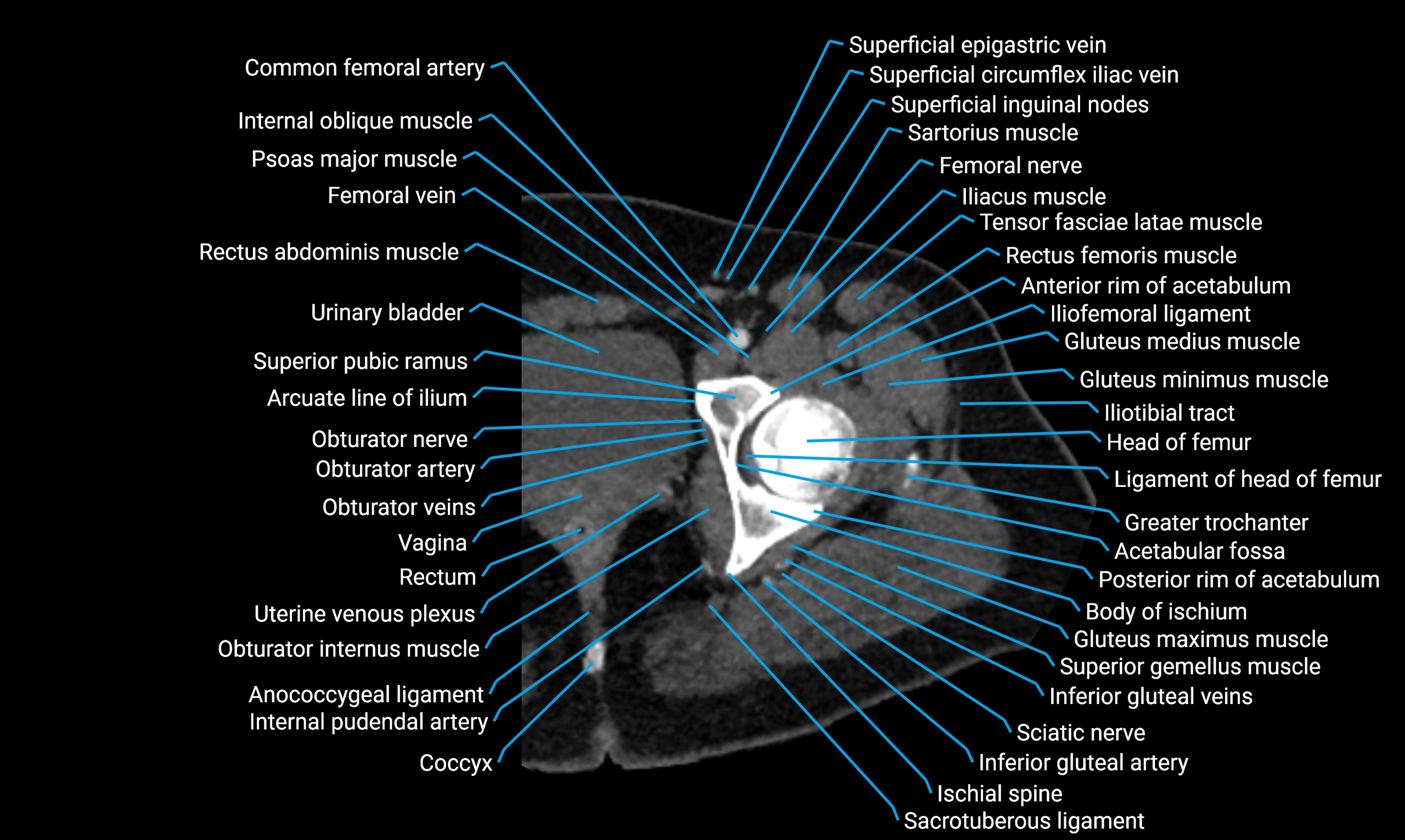 CT Lower Limb Anatomy – Normal Labeled CT Axial, Coronal, Sagittal ...
