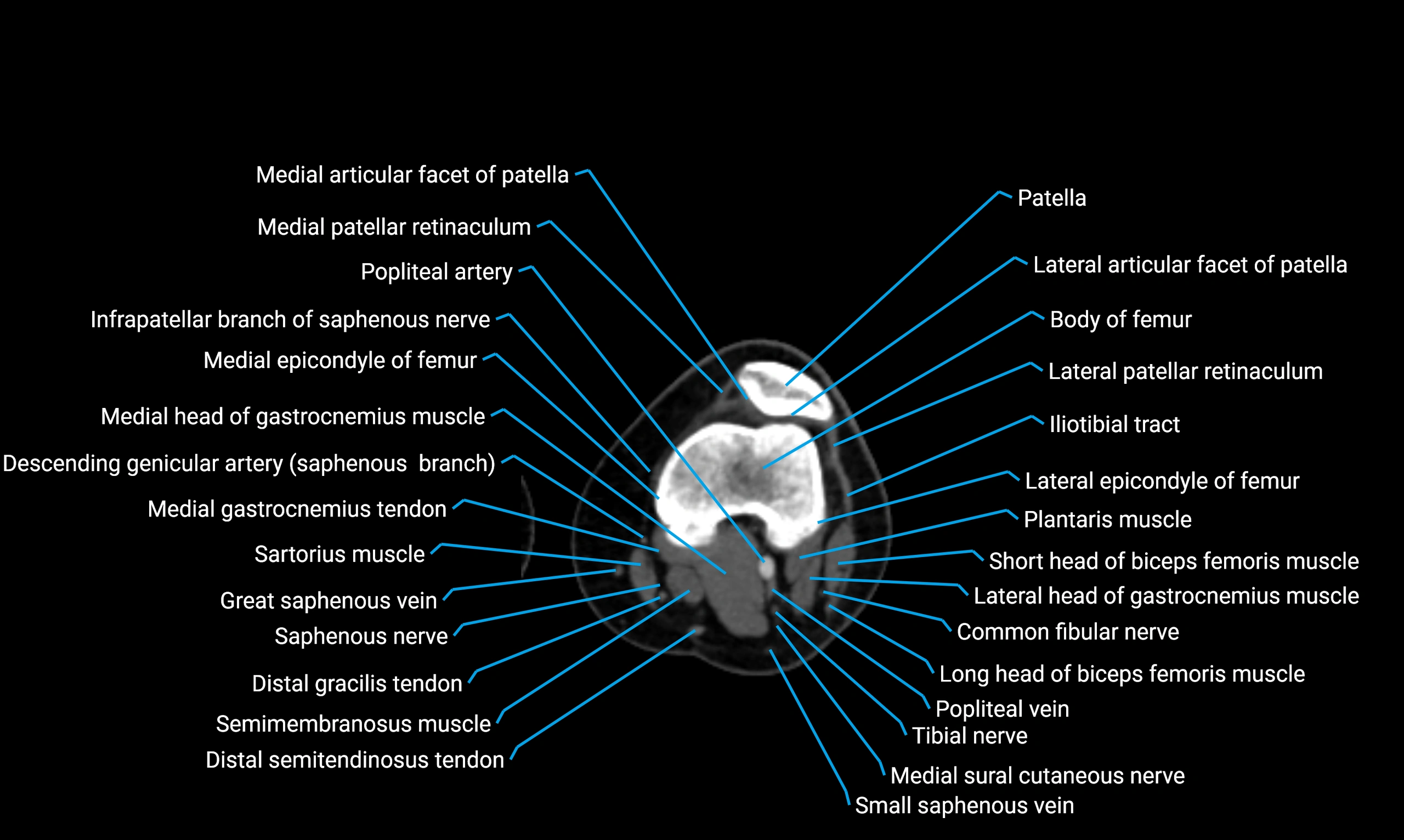 CT Lower Limb Anatomy – Normal Labeled CT Axial, Coronal, Sagittal ...