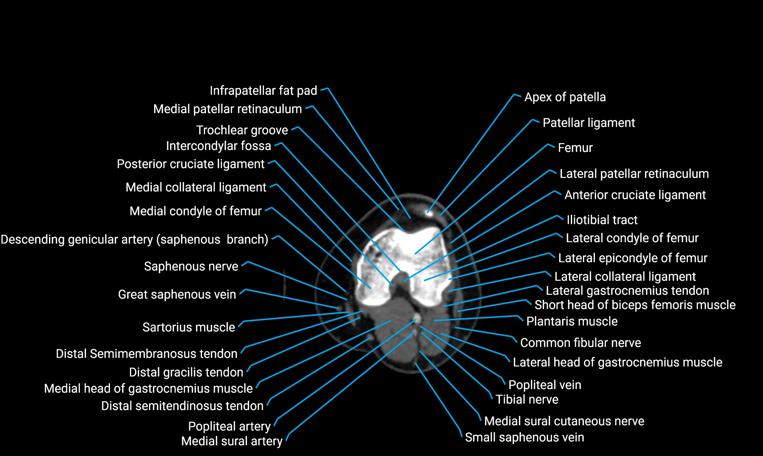 CT Lower Limb Anatomy – Normal Labeled CT Axial, Coronal, Sagittal ...