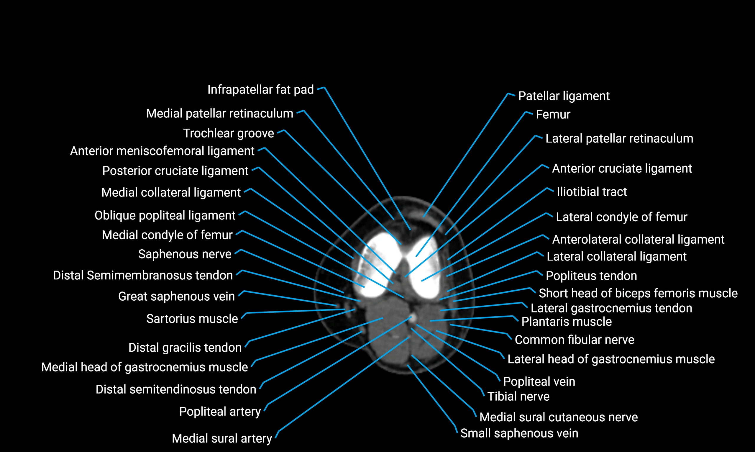 CT Lower Limb Anatomy – Normal Labeled CT Axial, Coronal, Sagittal ...