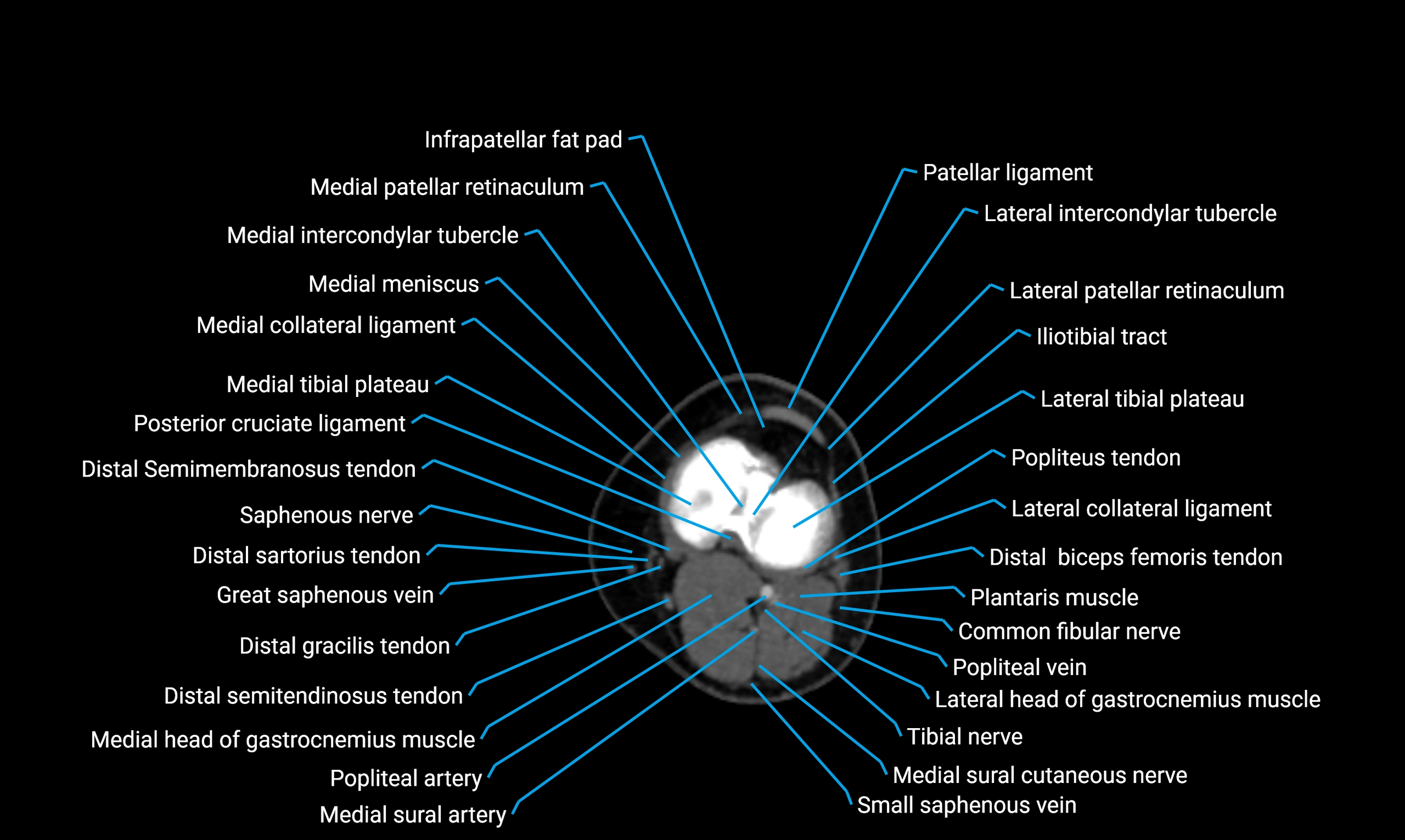 CT Lower Limb Anatomy – Normal Labeled CT Axial, Coronal, Sagittal ...